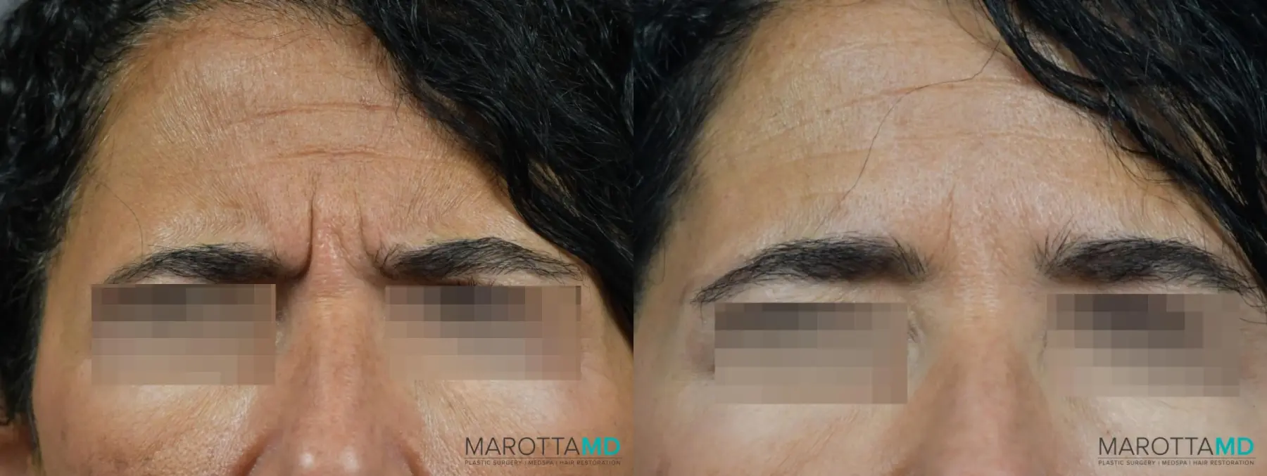 Botox - Glabella: Patient 10 - Before and After  