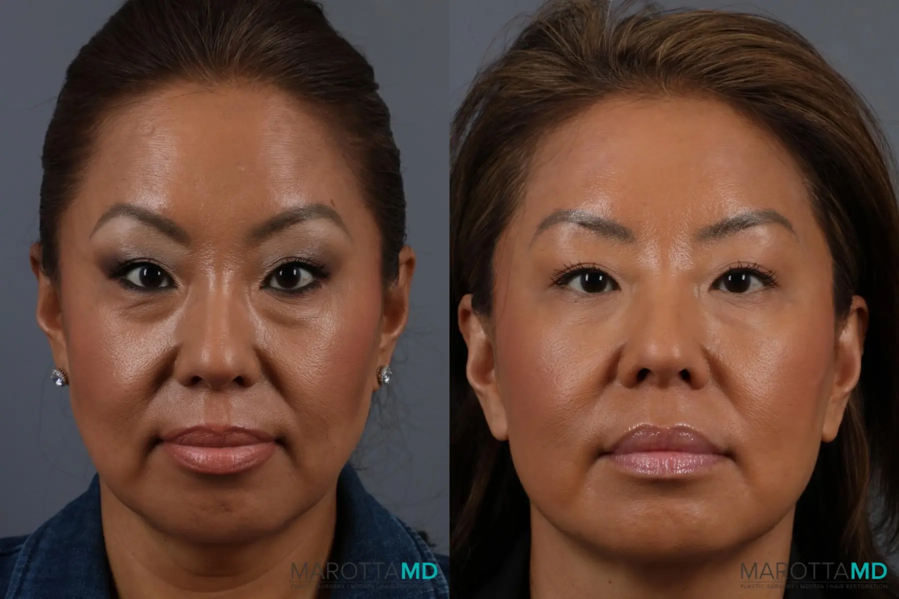 Botox - Glabella: Patient 1 - Before and After  