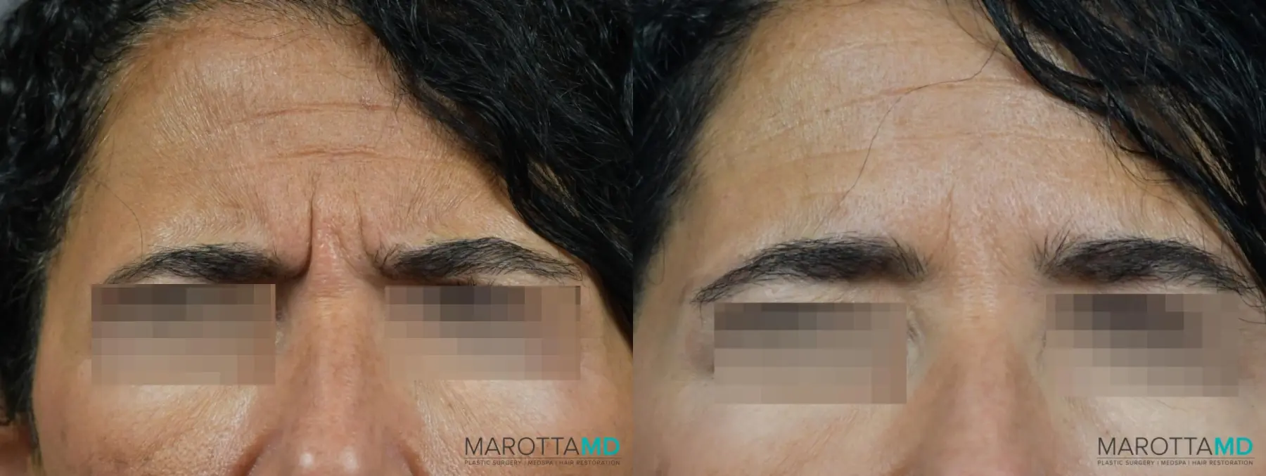 Botox - Glabella: Patient 9 - Before and After  