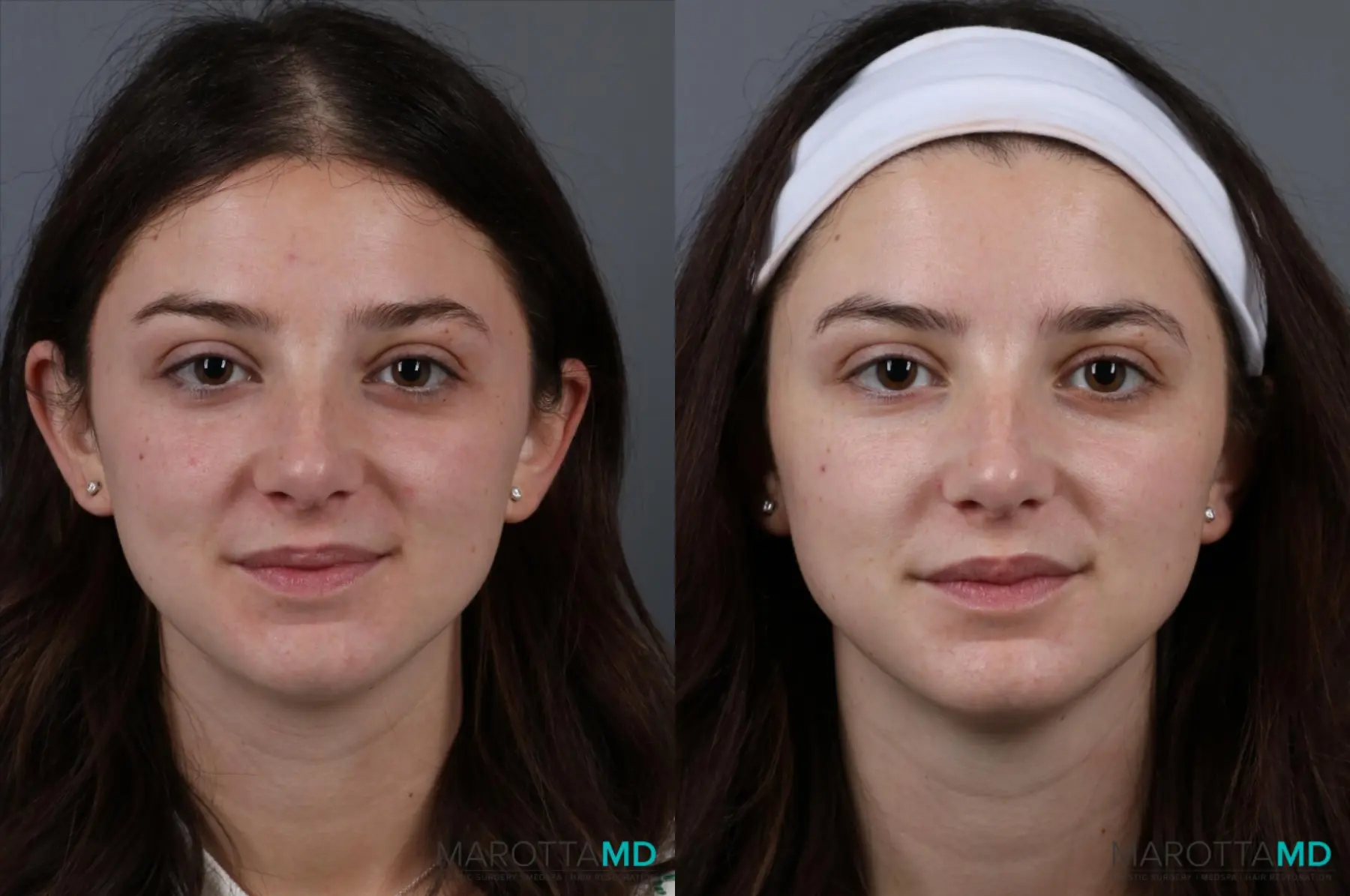 Botox - Lip Flip: Patient 1 - Before and After  