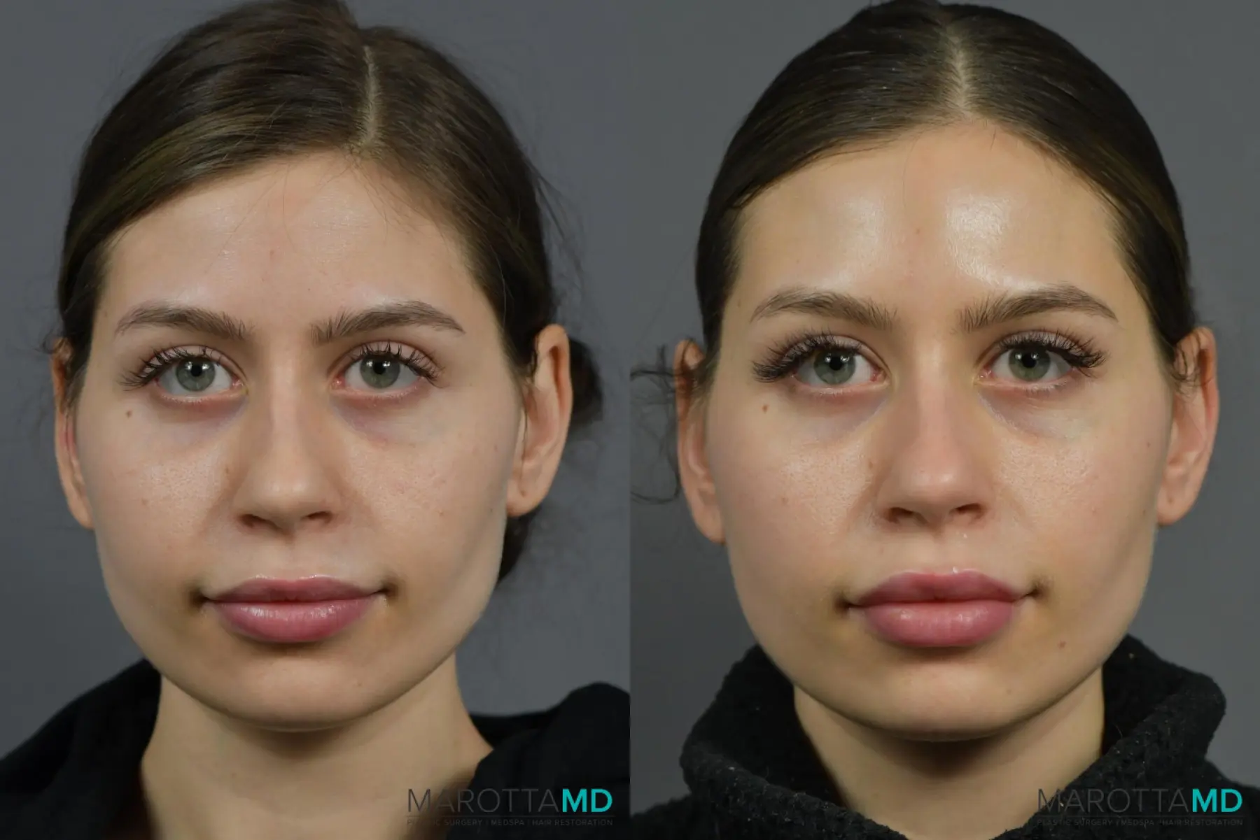 Botox - Lip Flip: Patient 3 - Before and After  