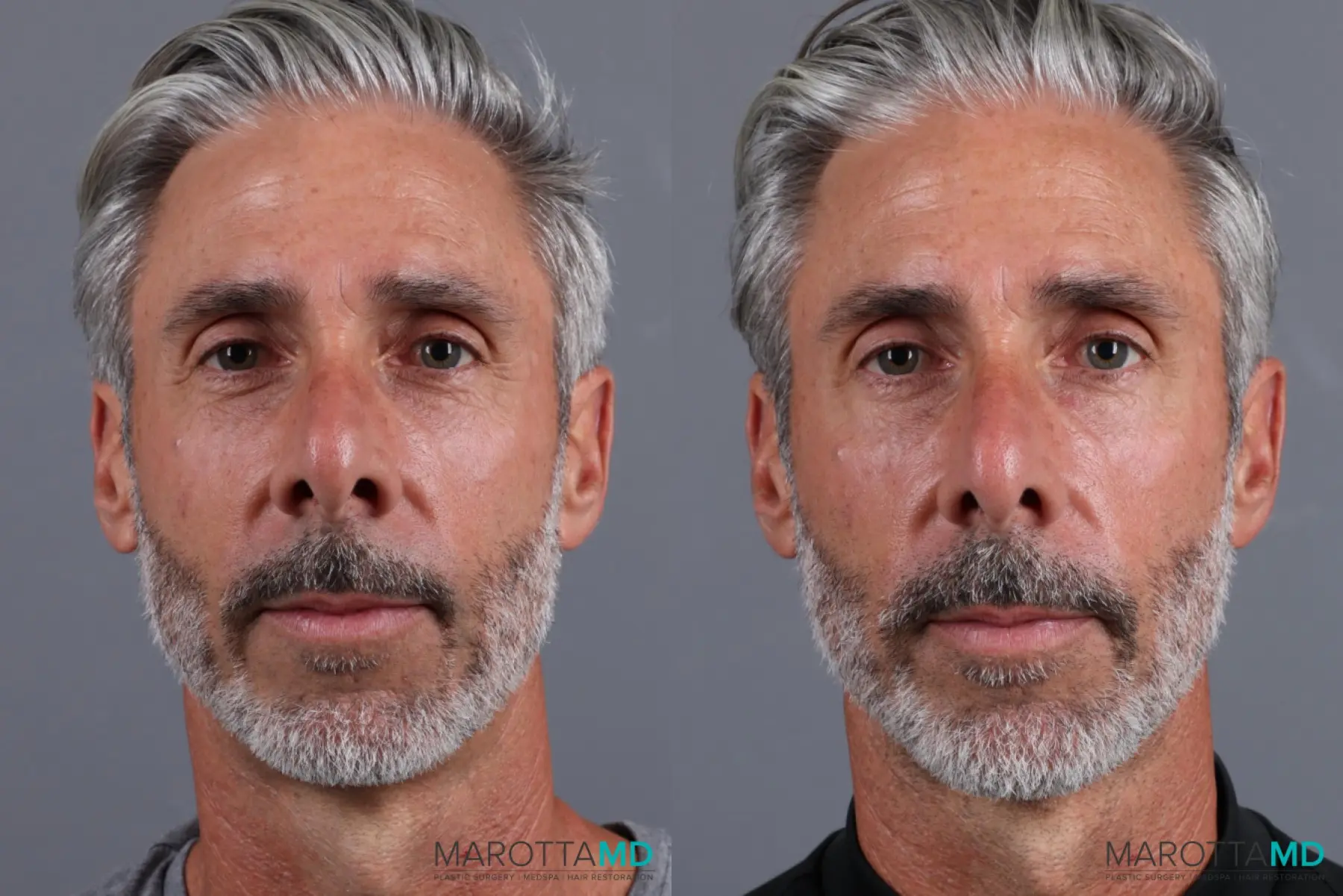 BOTOX® Cosmetic: Patient 8 - Before and After  