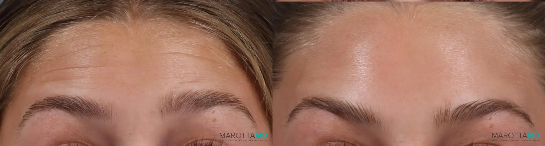 BOTOX® Cosmetic: Patient 1 - Before and After  