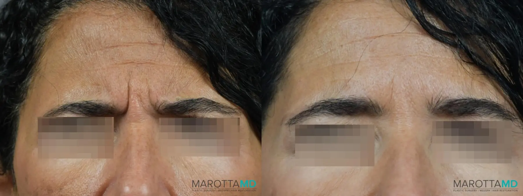 BOTOX® Cosmetic: Patient 5 - Before and After  