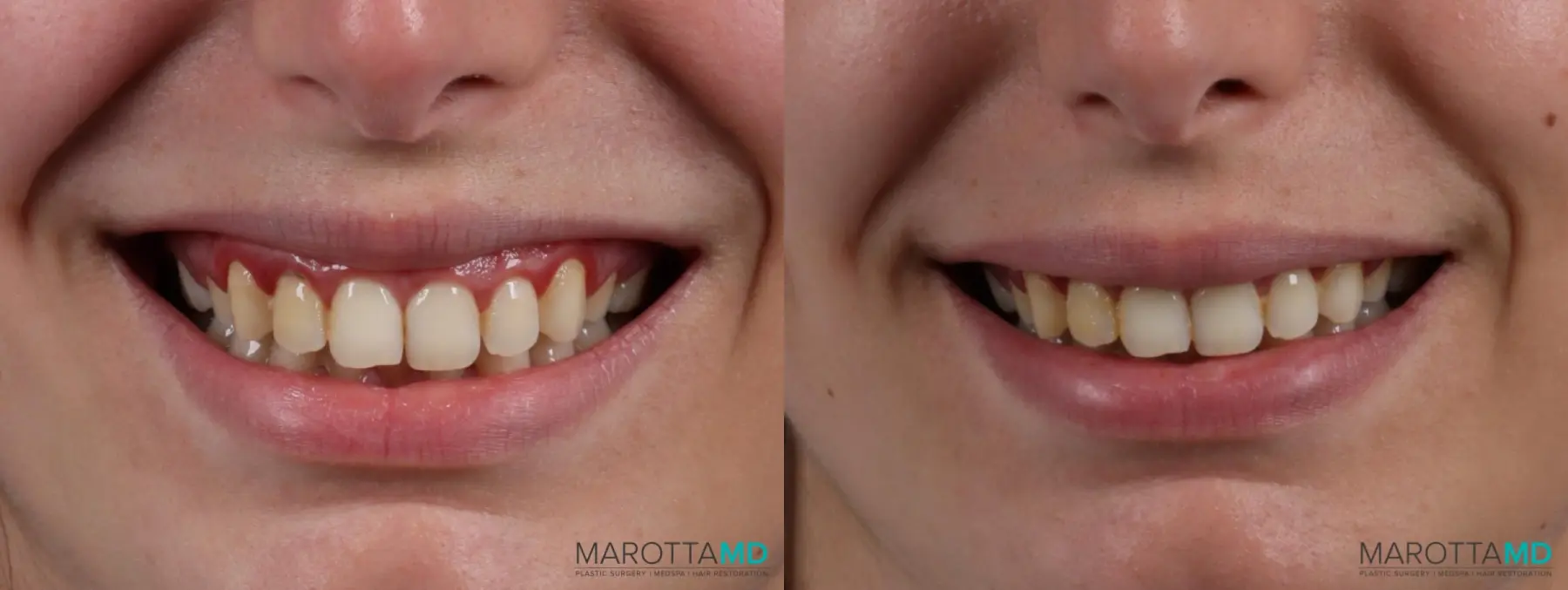 Botox Gummy Smile - Before and After  