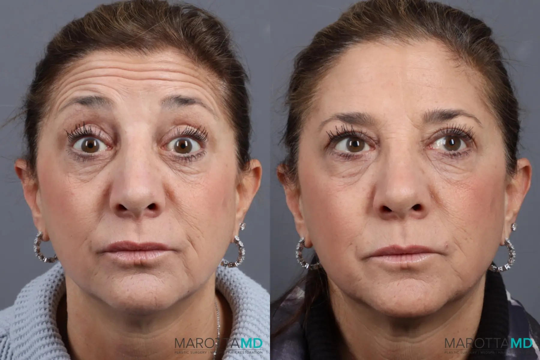 BOTOX® Cosmetic: Patient 6 - Before and After  