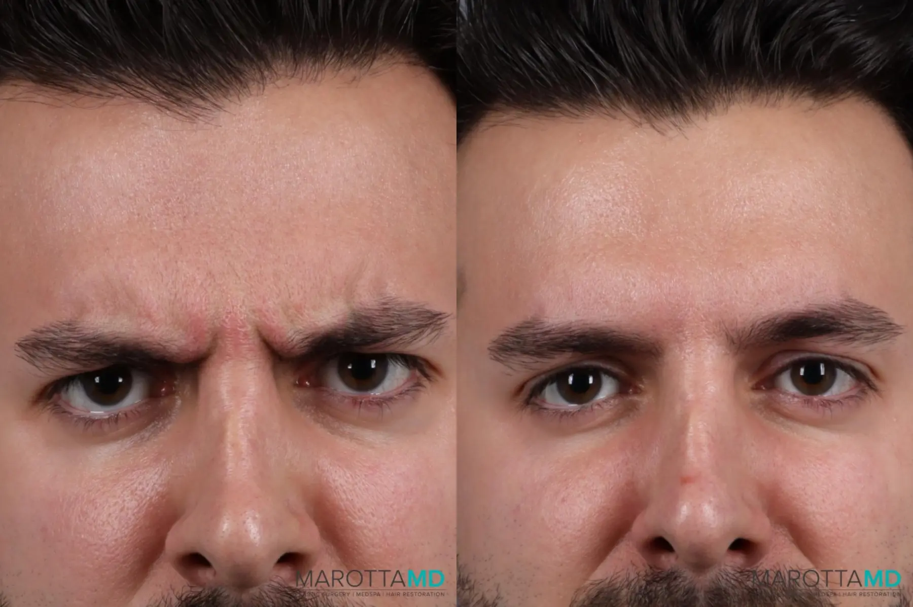 BOTOX® Cosmetic: Patient 2 - Before and After  