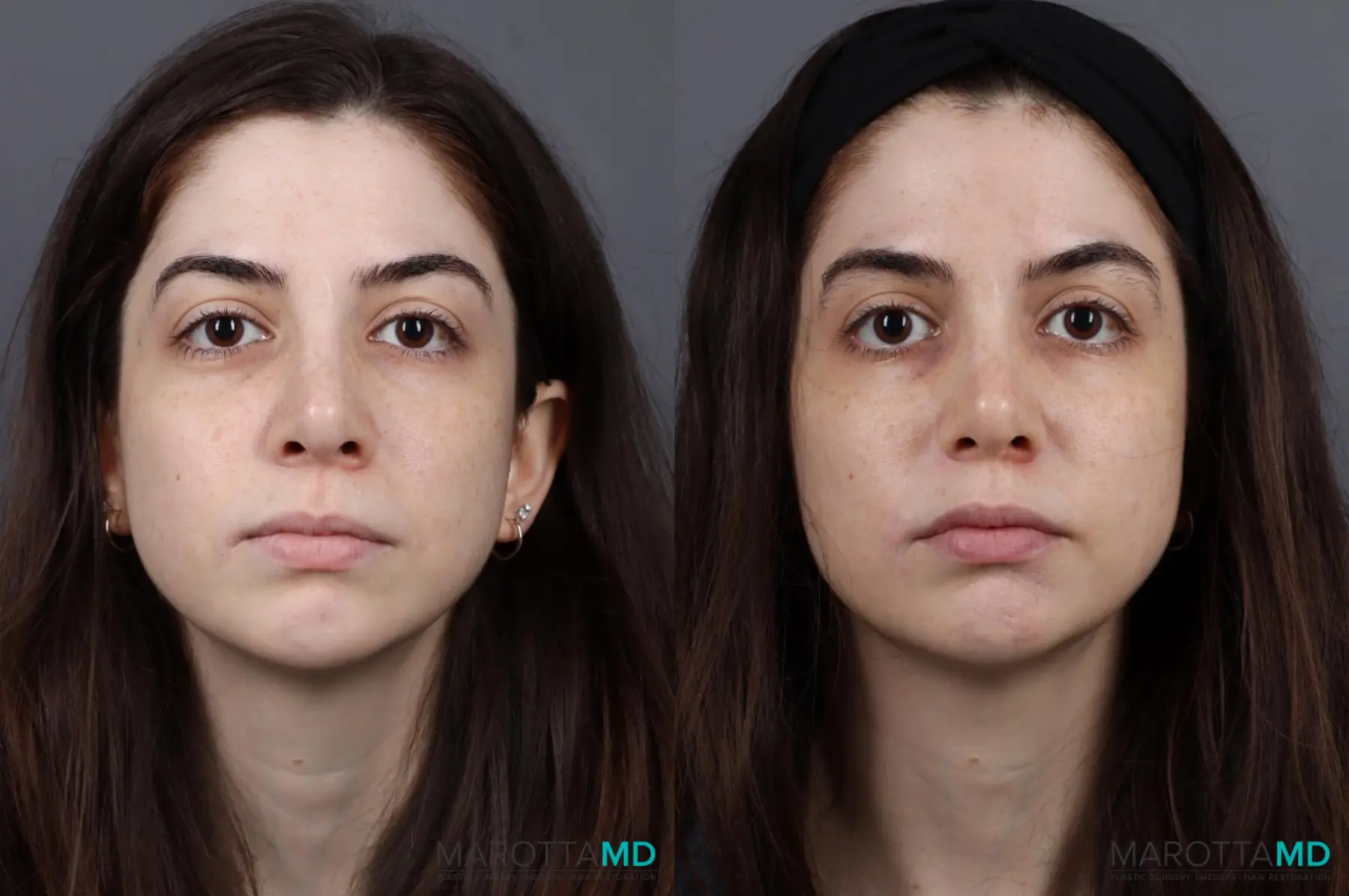 Botox - Gummy Smile: Patient 1 - Before and After  