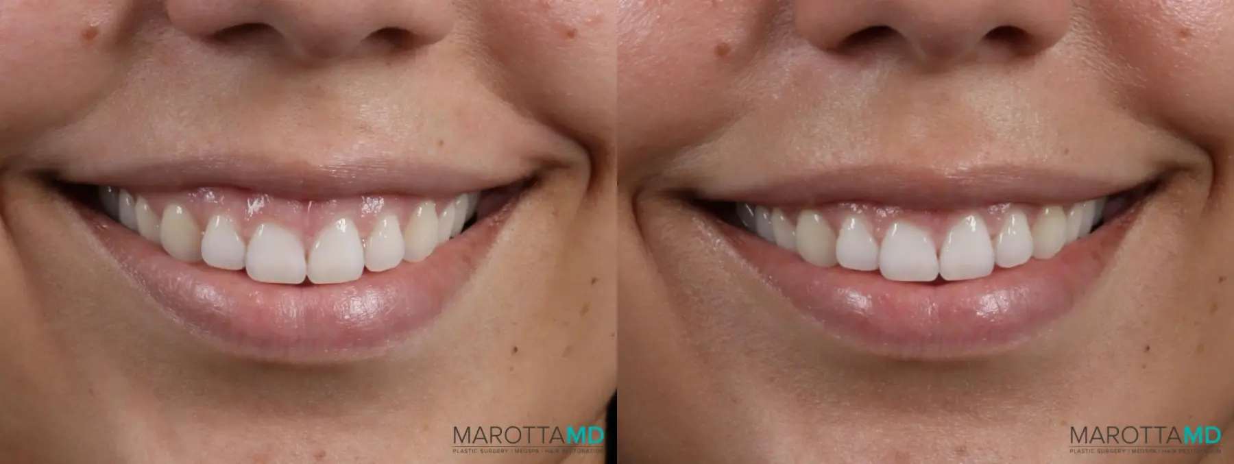 Botox Gummy Smile: Patient 1 - Before and After  