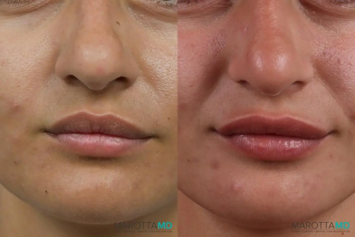 Botox - Lip Flip: Patient 2 - Before and After  