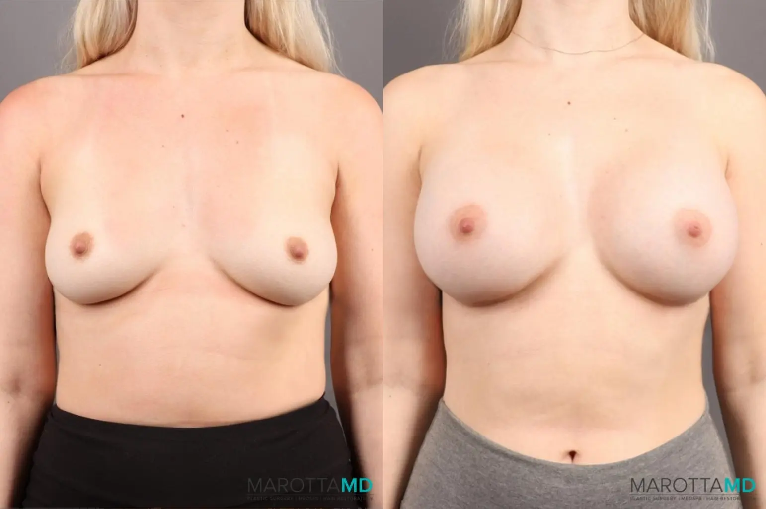 Breast Augmentation: Patient 2 - Before and After  