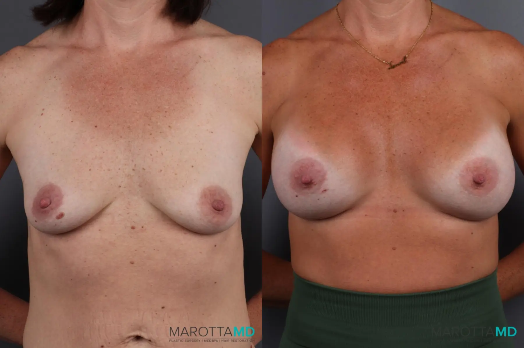 Breast Augmentation: Patient 10 - Before and After  