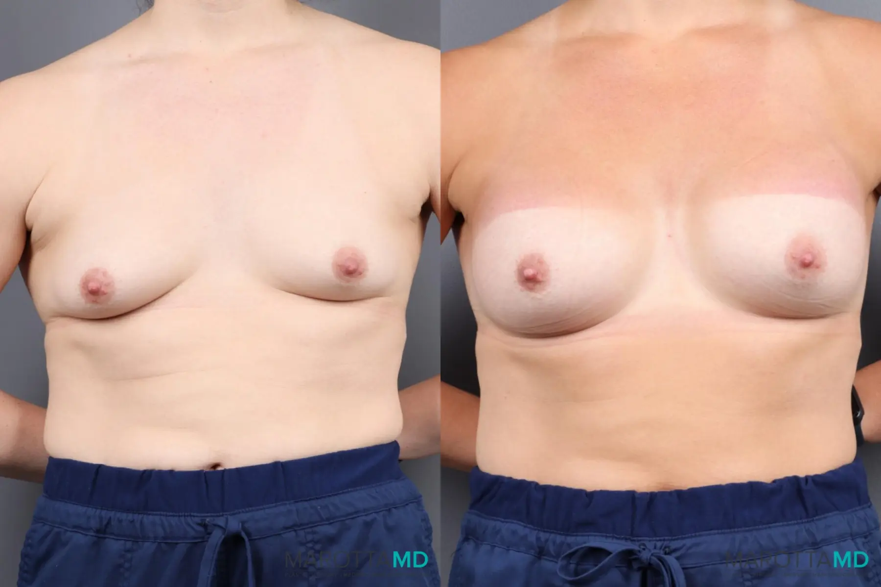 Breast Augmentation: Patient 5 - Before and After  