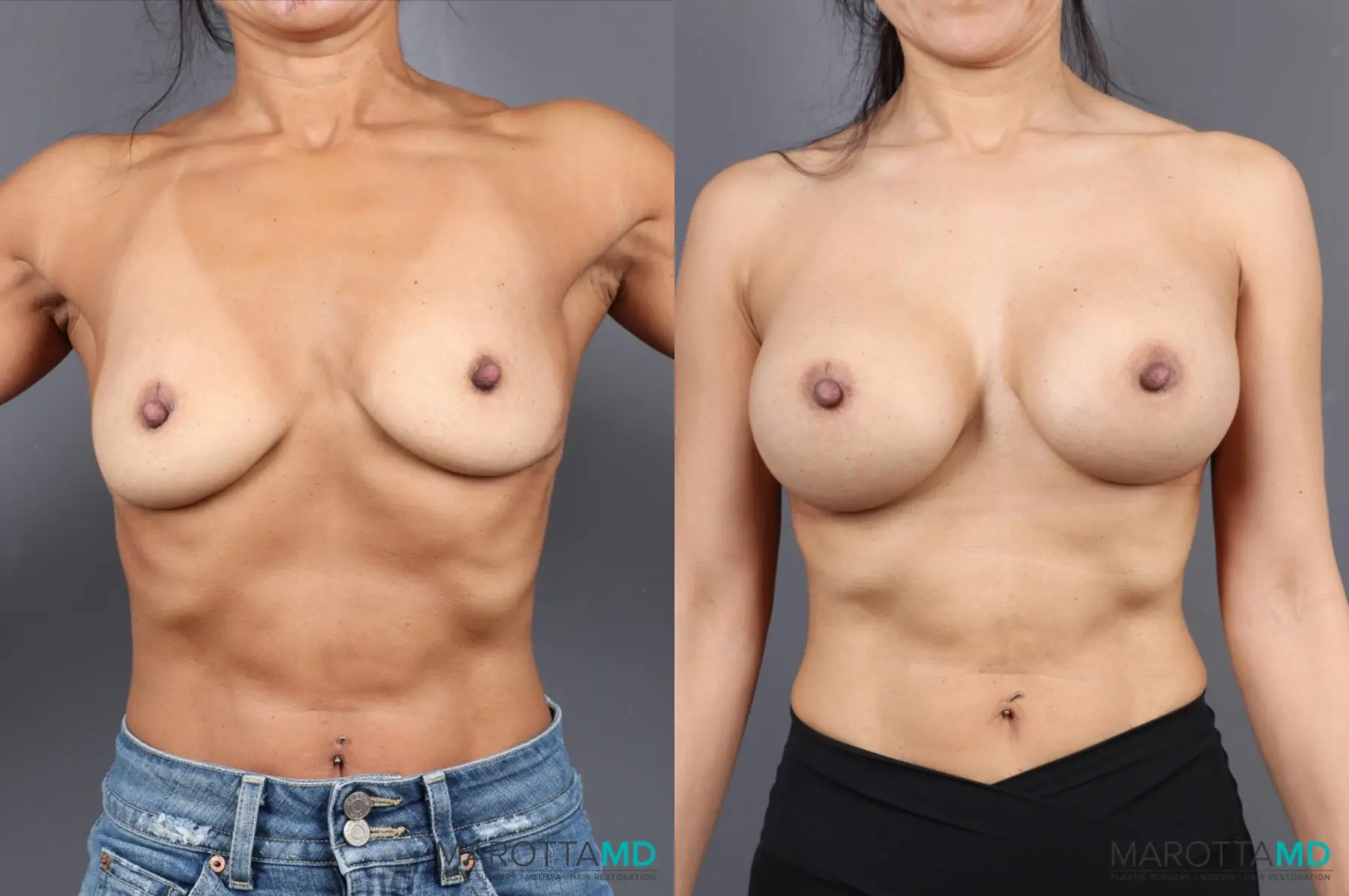 Breast Augmentation: Patient 4 - Before and After  