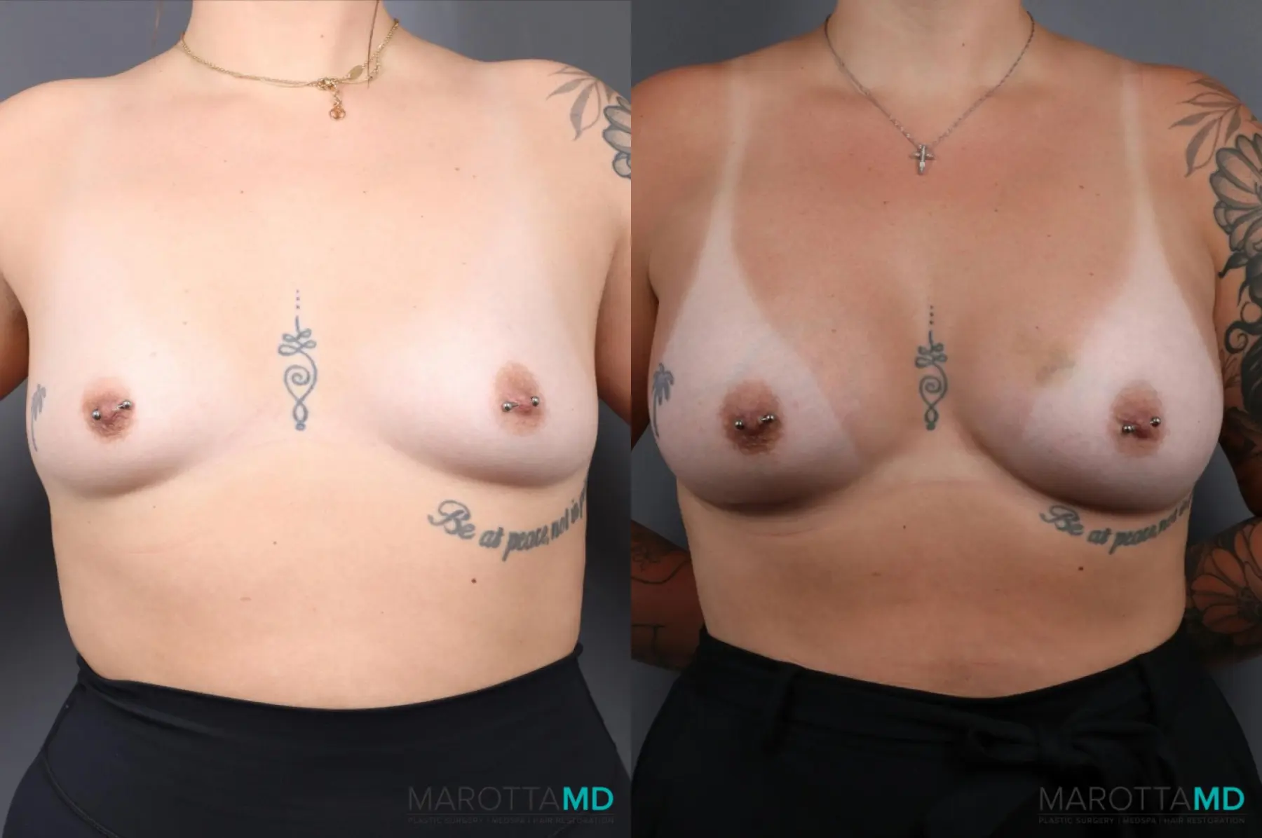 Breast Augmentation: Patient 7 - Before and After  