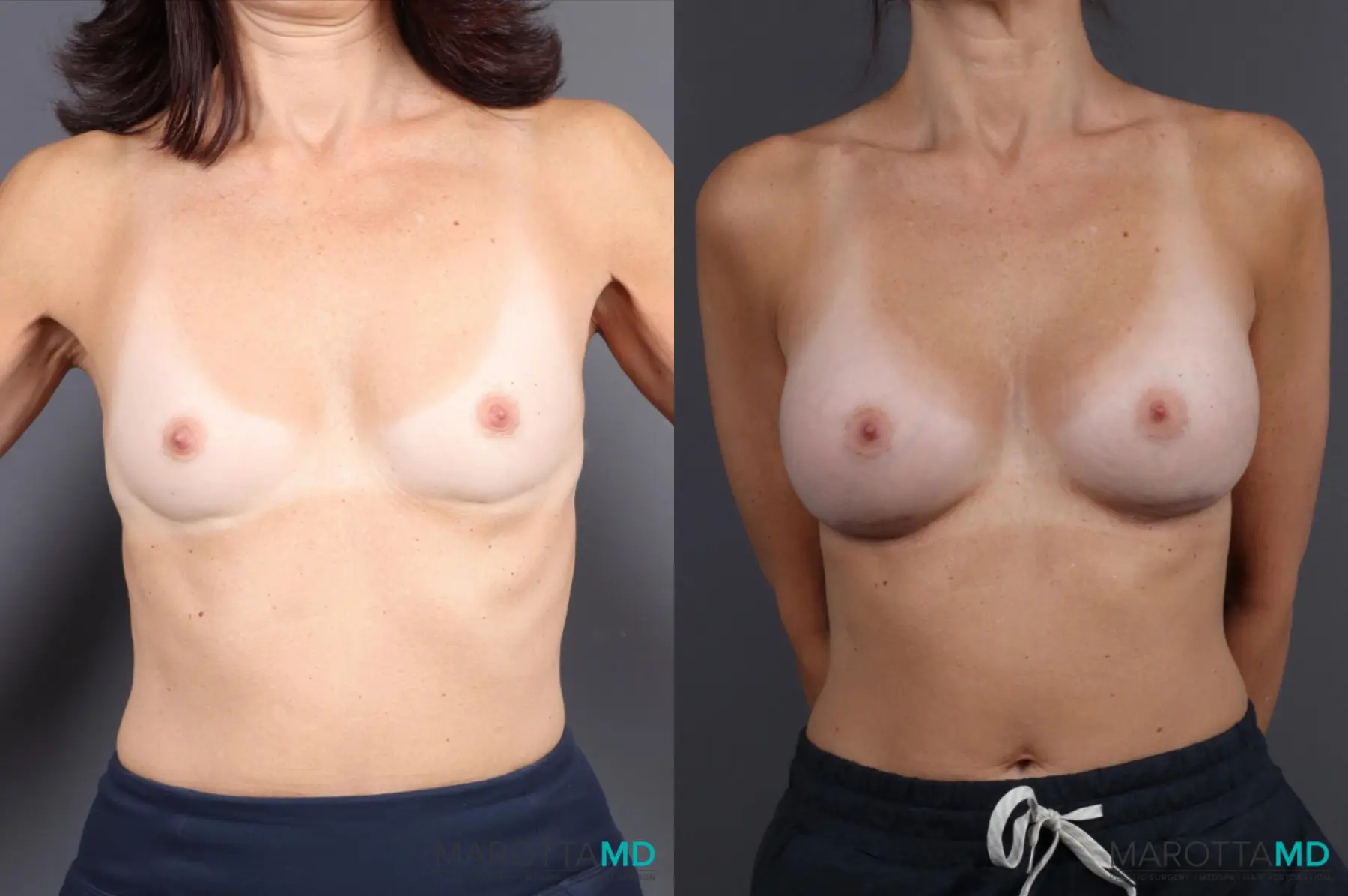 Breast Augmentation: Patient 8 - Before and After  