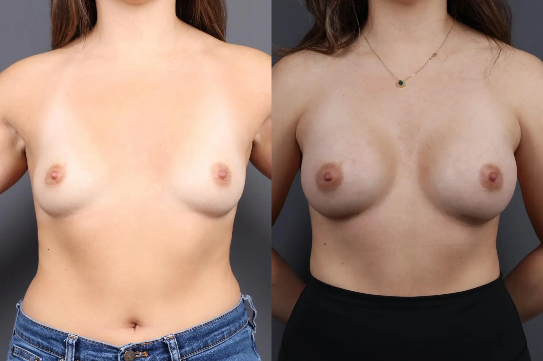 Breast Augmentation: Patient 5 - Before and After  