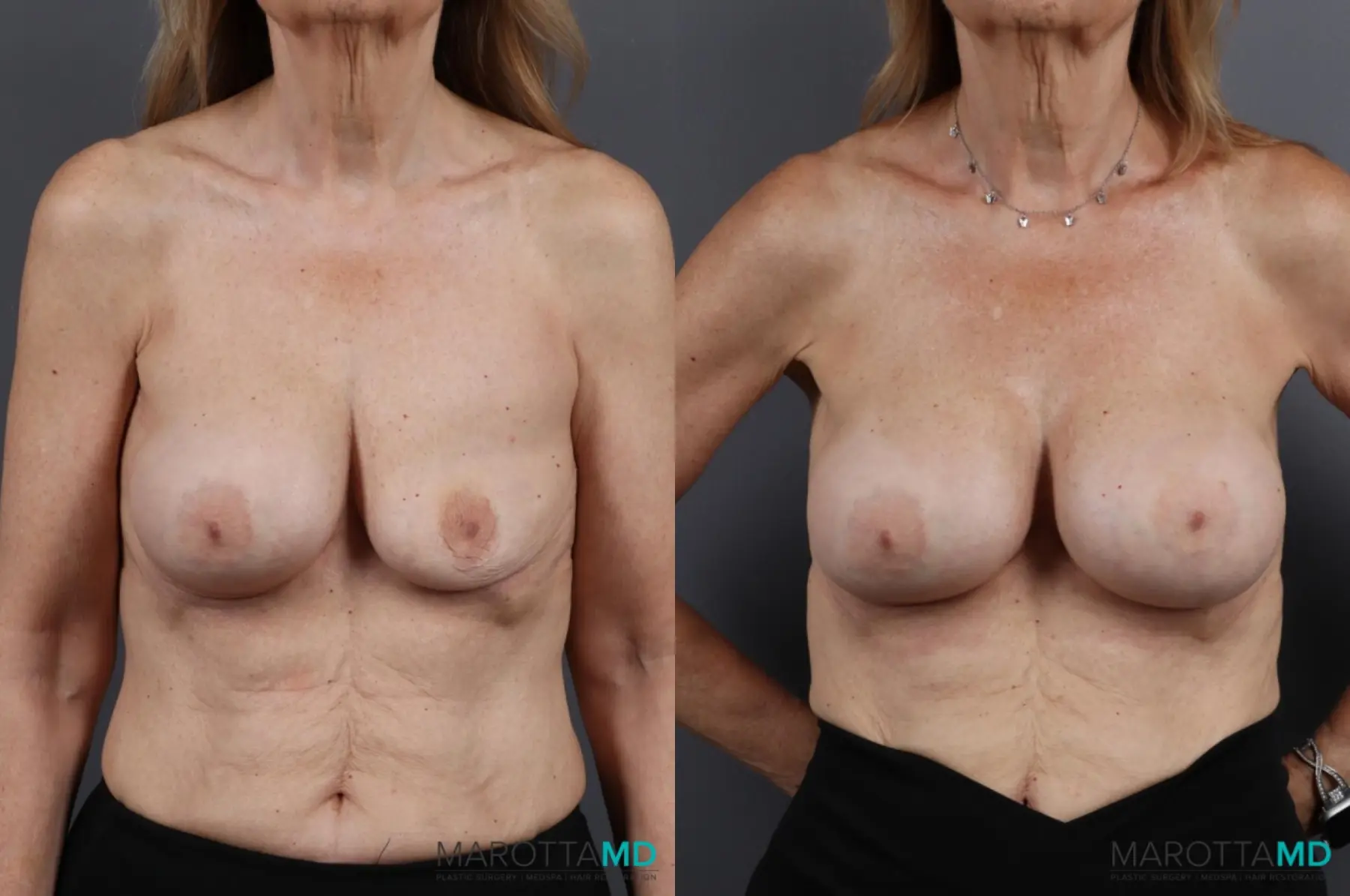 Breast Implant Exchange: Patient 2 - Before and After  