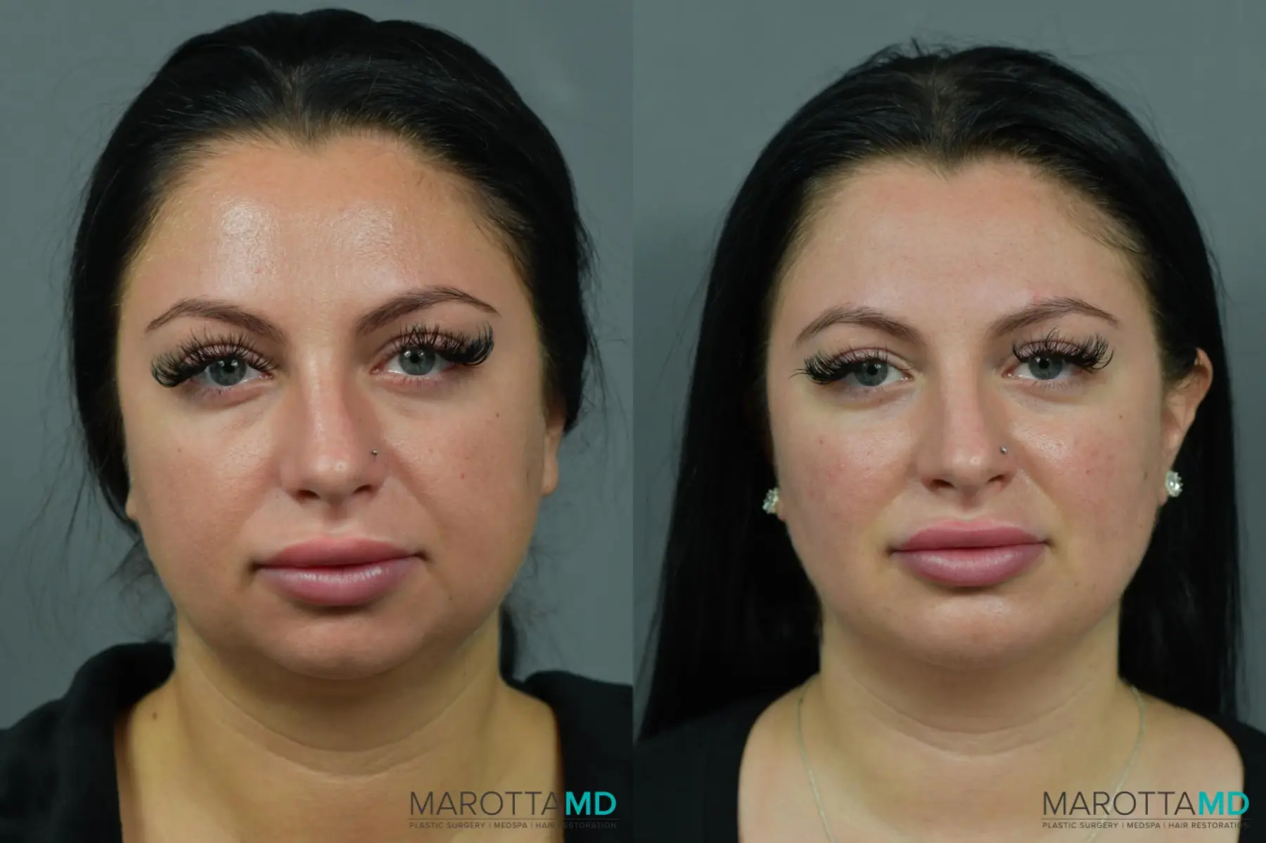 Buccal Fat Removal: Patient 2 - Before and After  