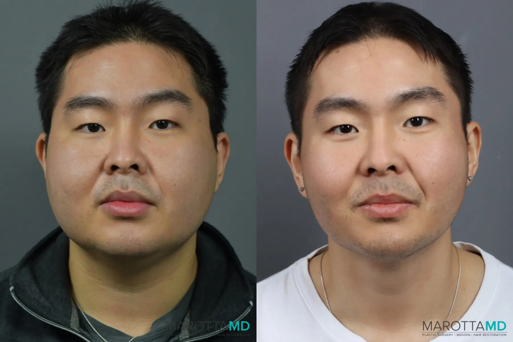 Buccal Fat Removal: Patient 1 - Before and After  