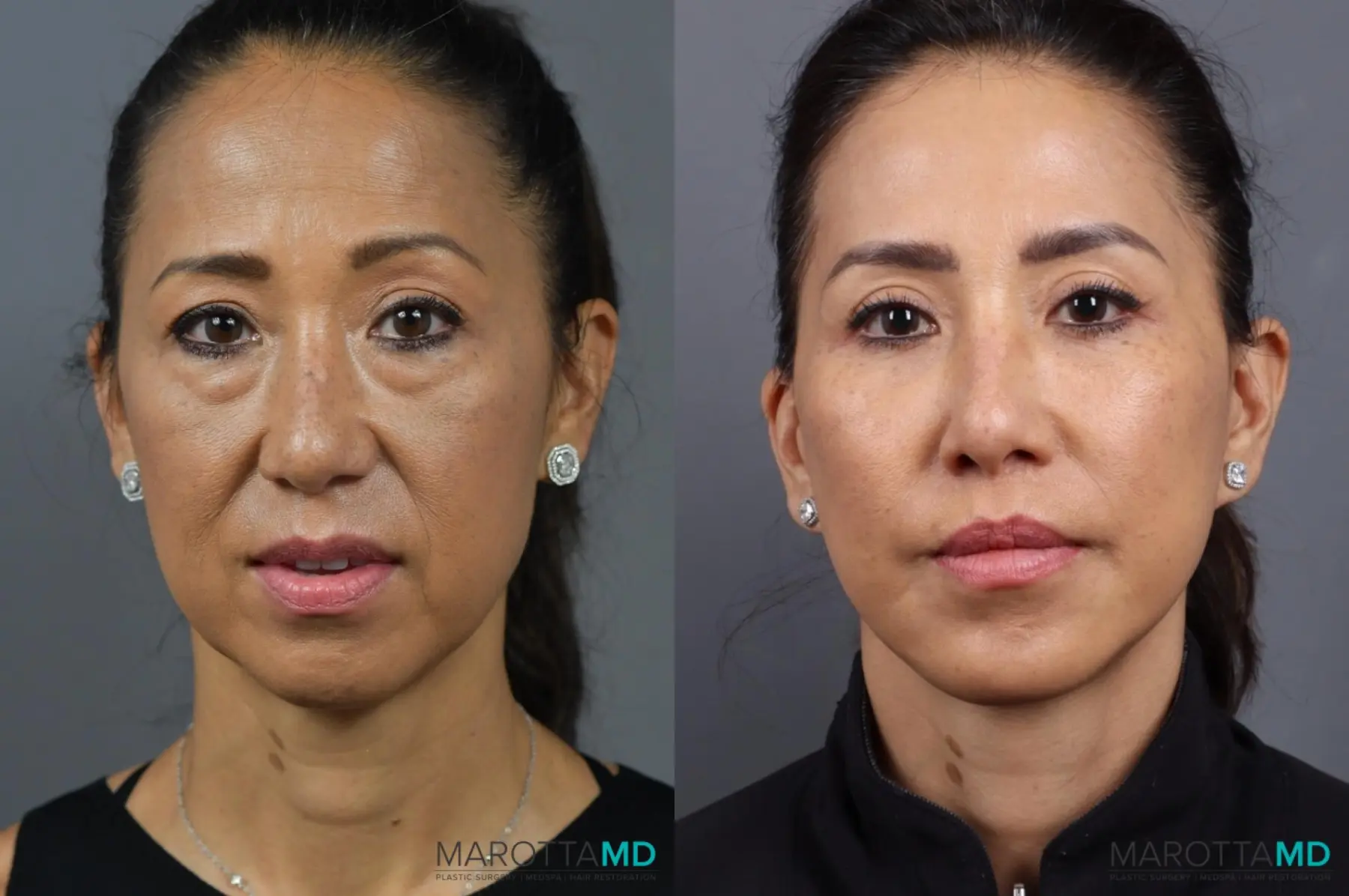 Buccal Fat Removal: Patient 1 - Before and After  