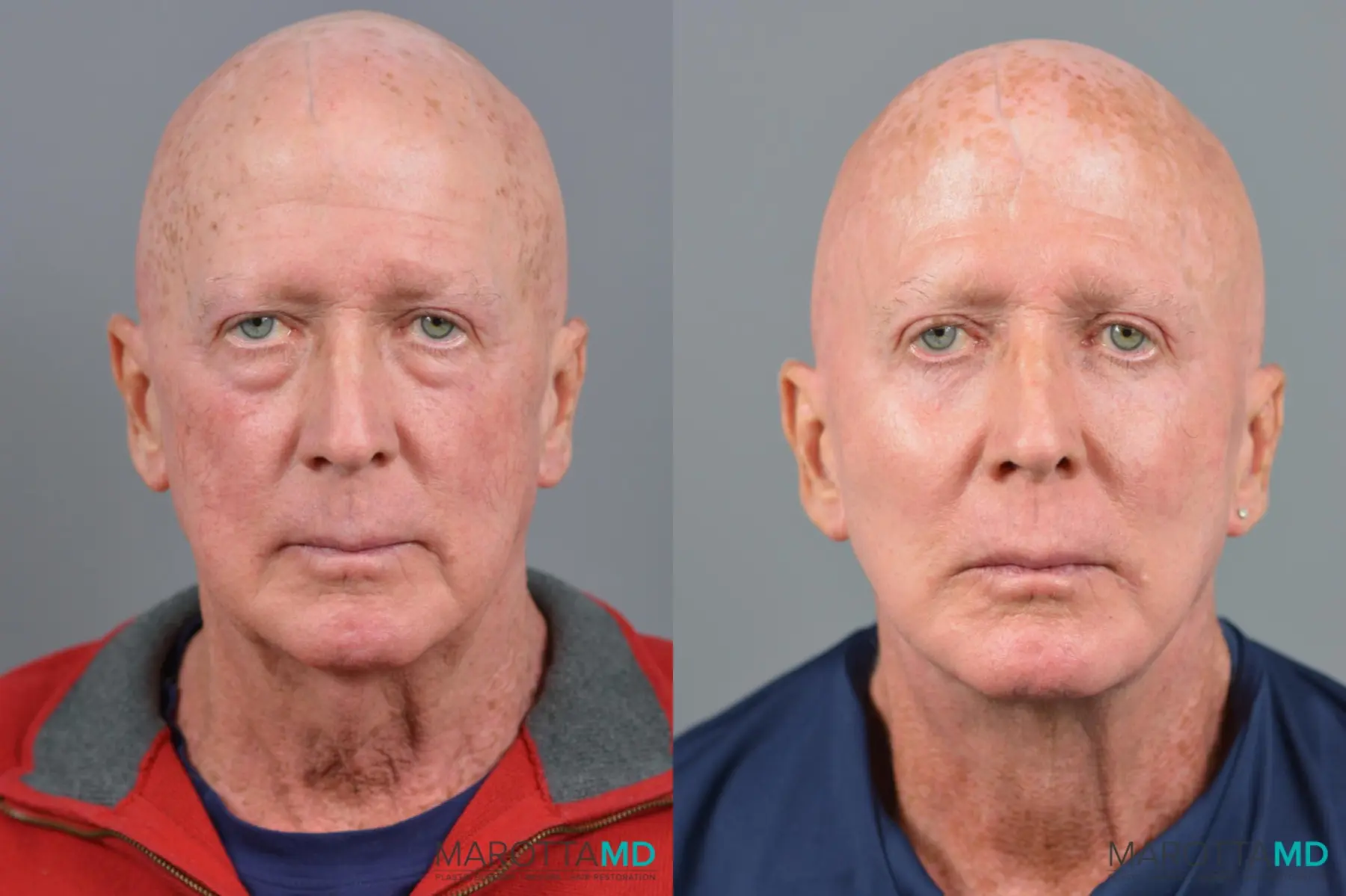 Cheek Augmentation: Patient 1 - Before and After  