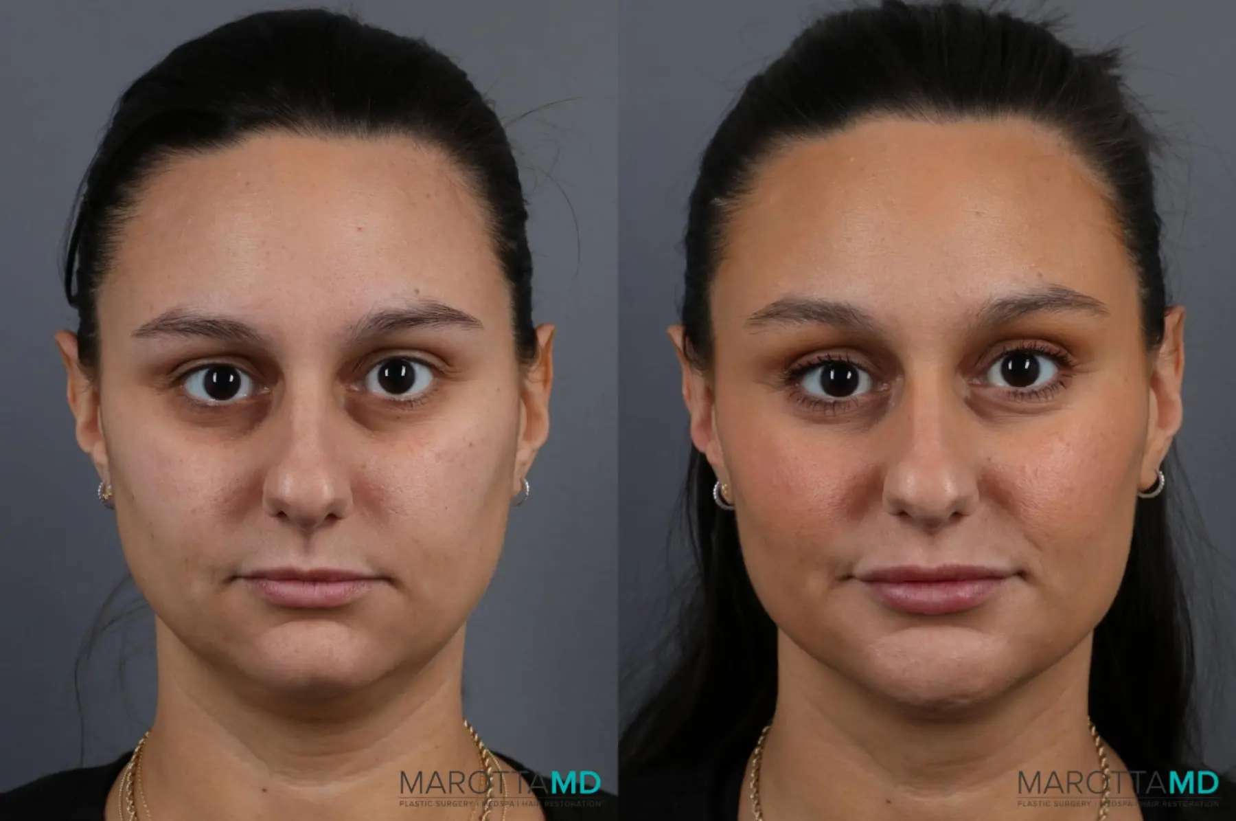 Filler - Cheek: Patient 1 - Before and After  