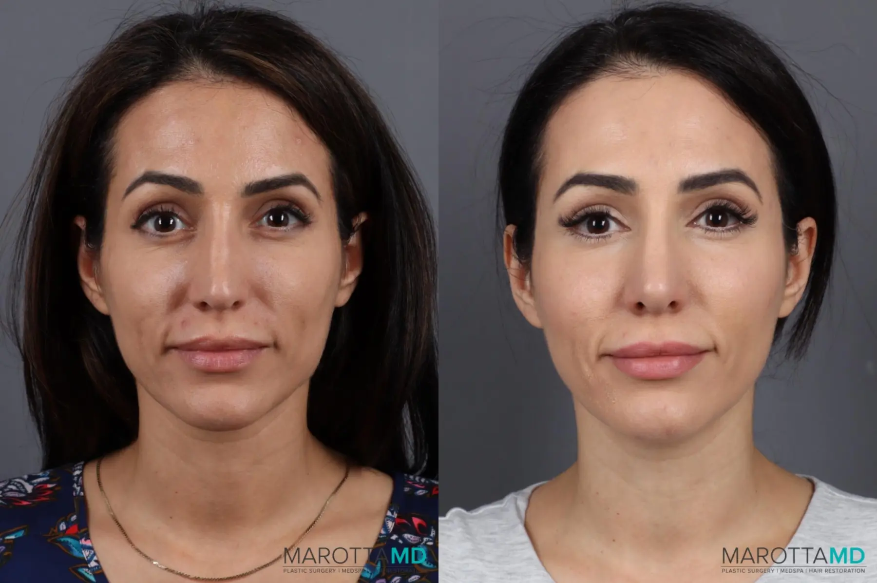 Filler - Cheek: Patient 2 - Before and After  