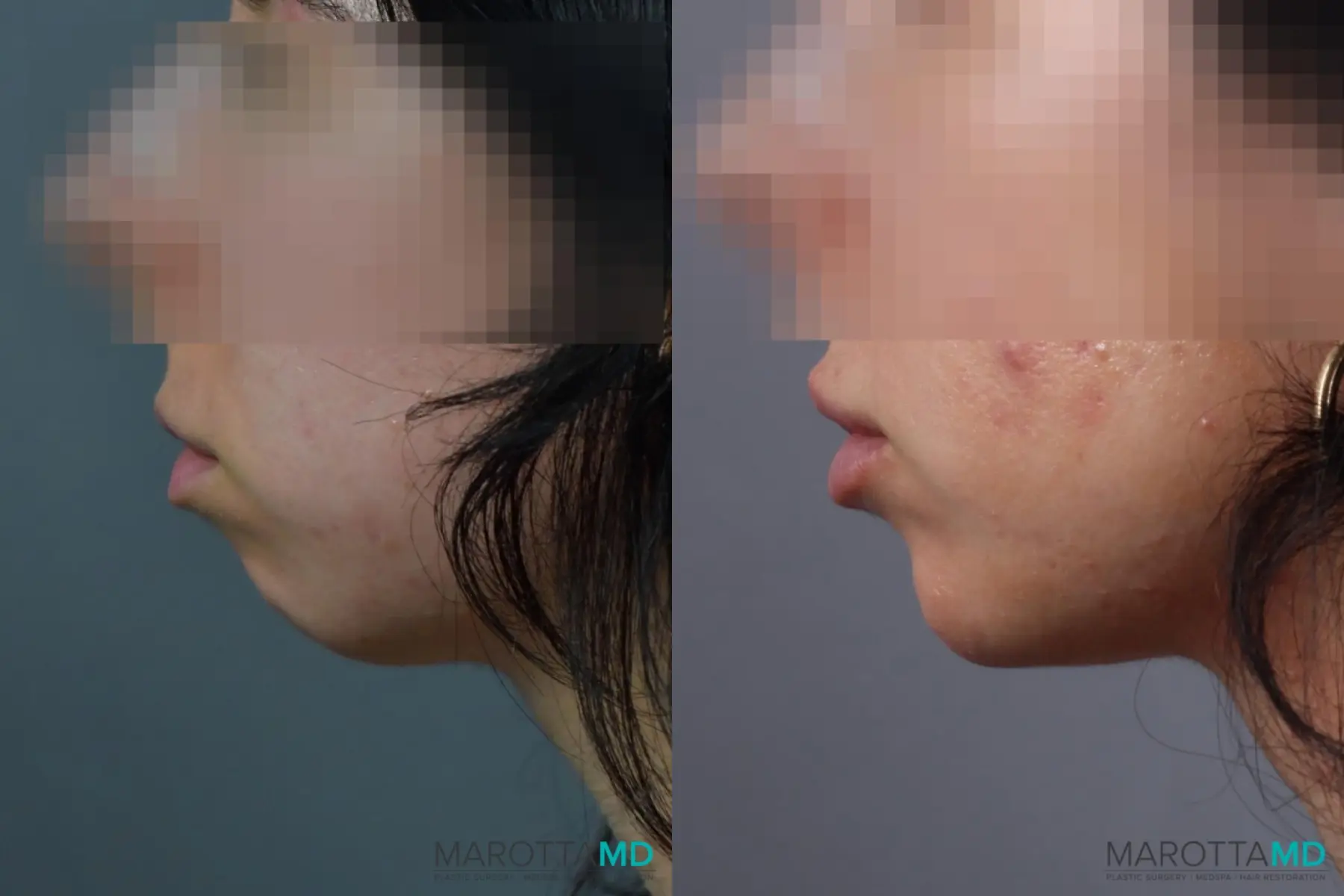 Chin Enhancement, Non-Surgical: Patient 1 - Before and After  