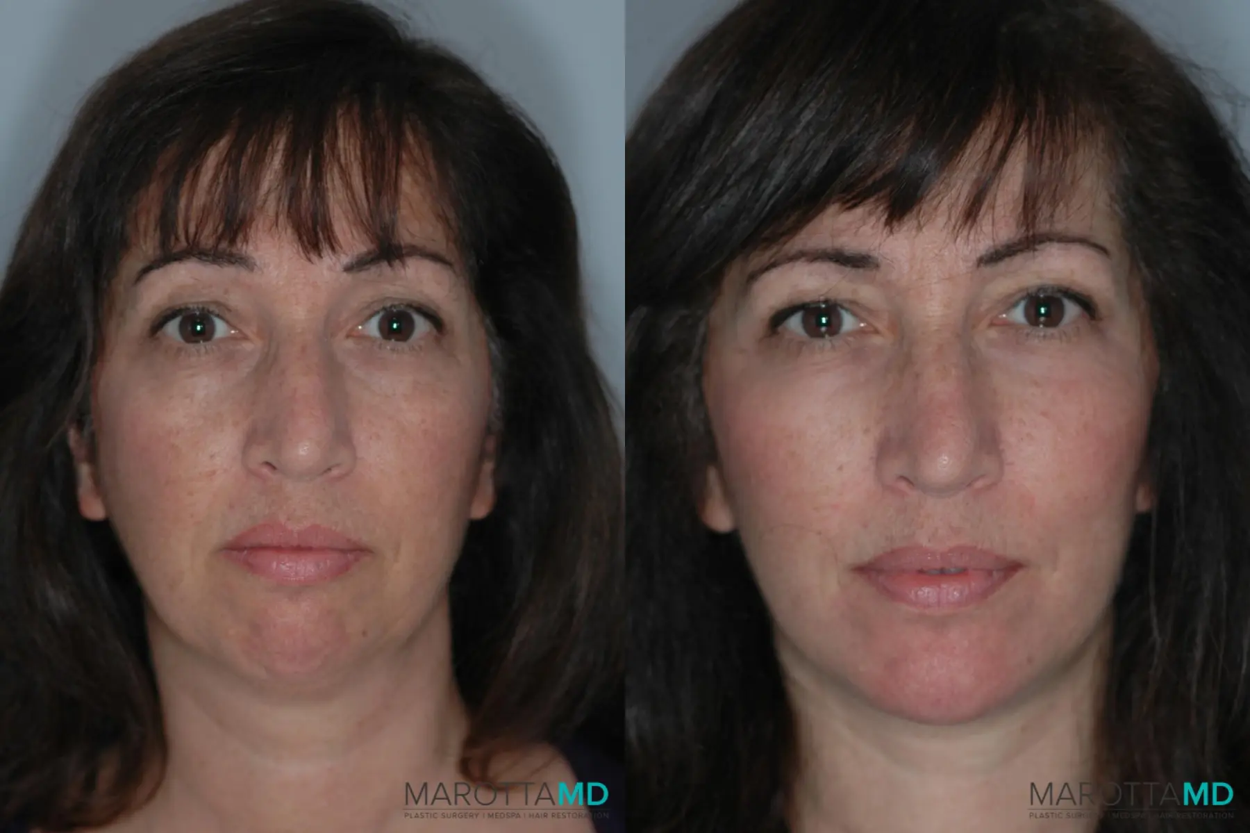 Chin Implant: Patient 4 - Before and After  