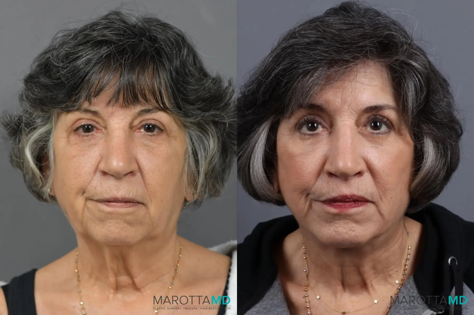 Chin Implant: Patient 3 - Before and After  