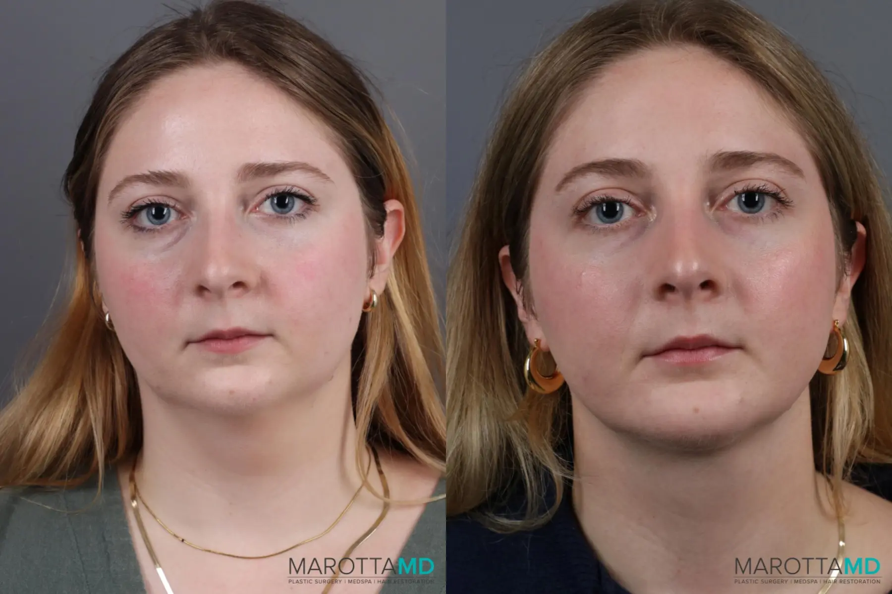 Chin Implant: Patient 6 - Before and After  