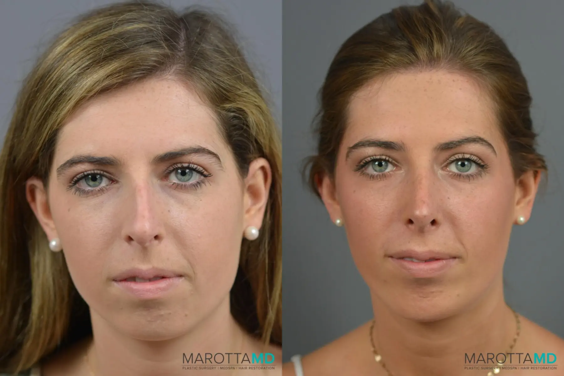 Chin Implant: Patient 5 - Before and After  