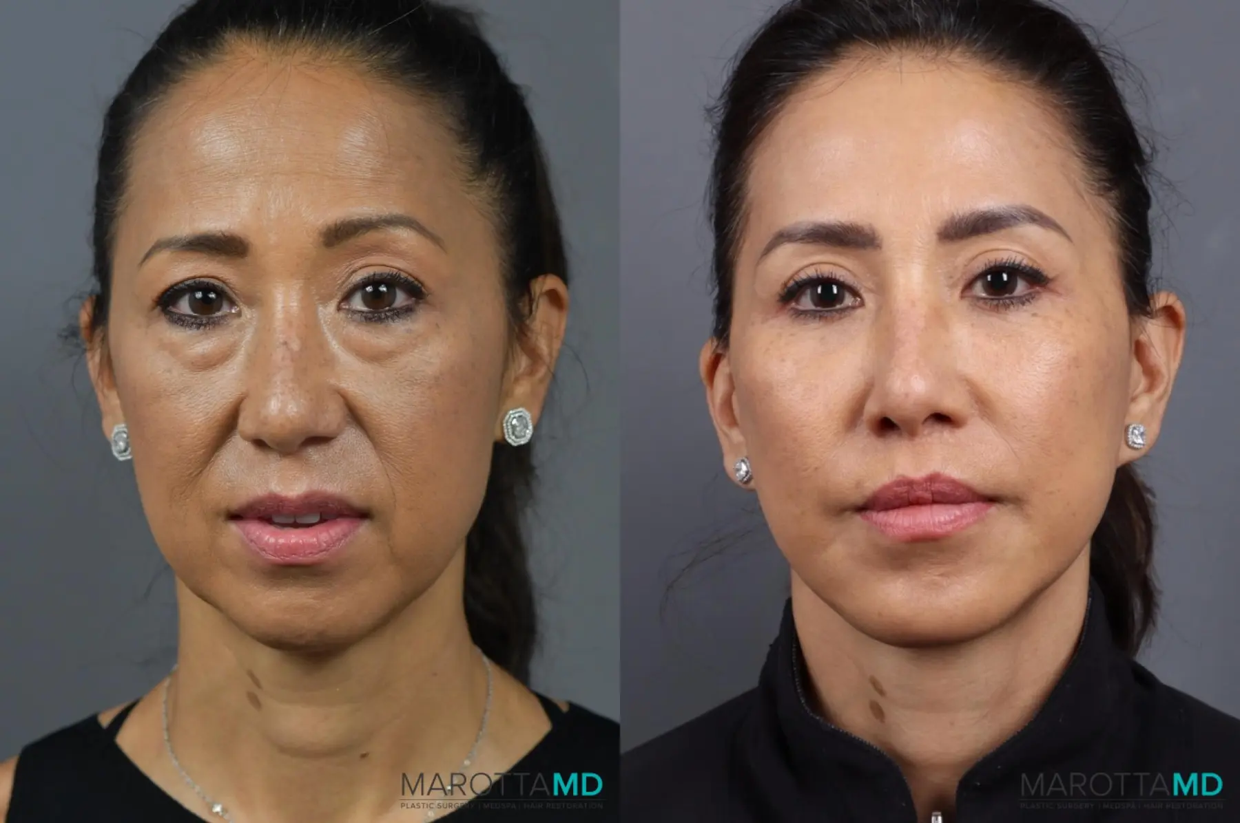 Chin Implant: Patient 1 - Before and After  