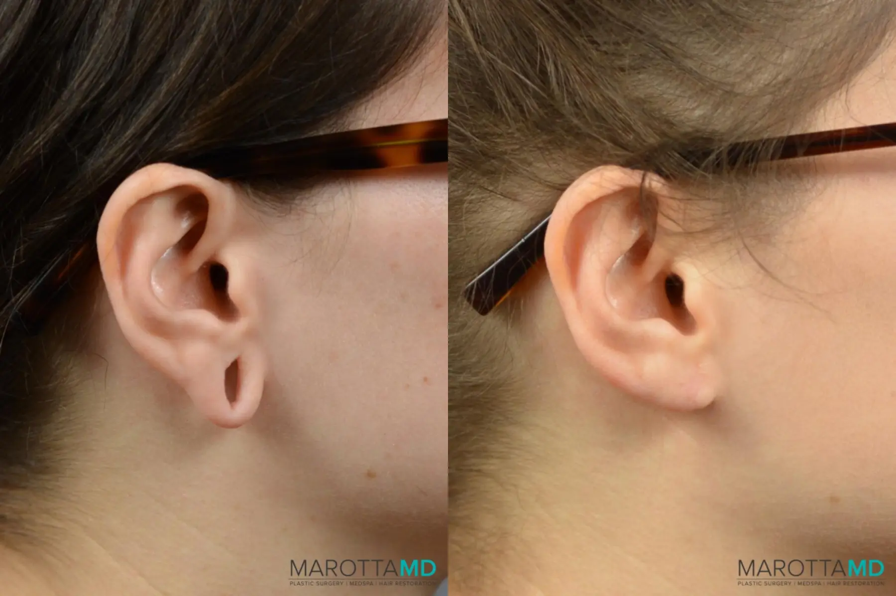 Earlobe Surgery: Patient 1 - Before and After  