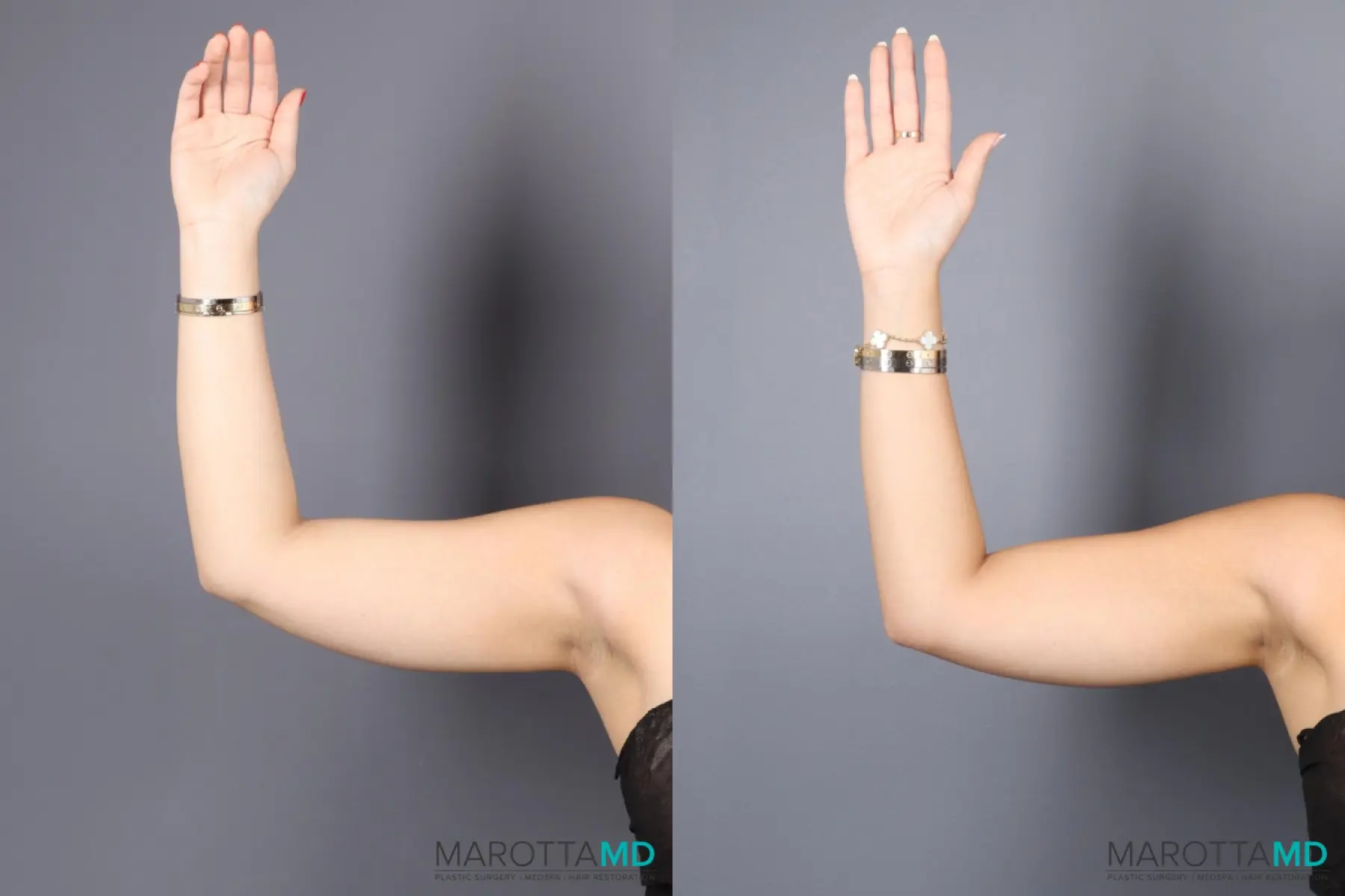 EMSCULPT®: Patient 2 - Before and After  