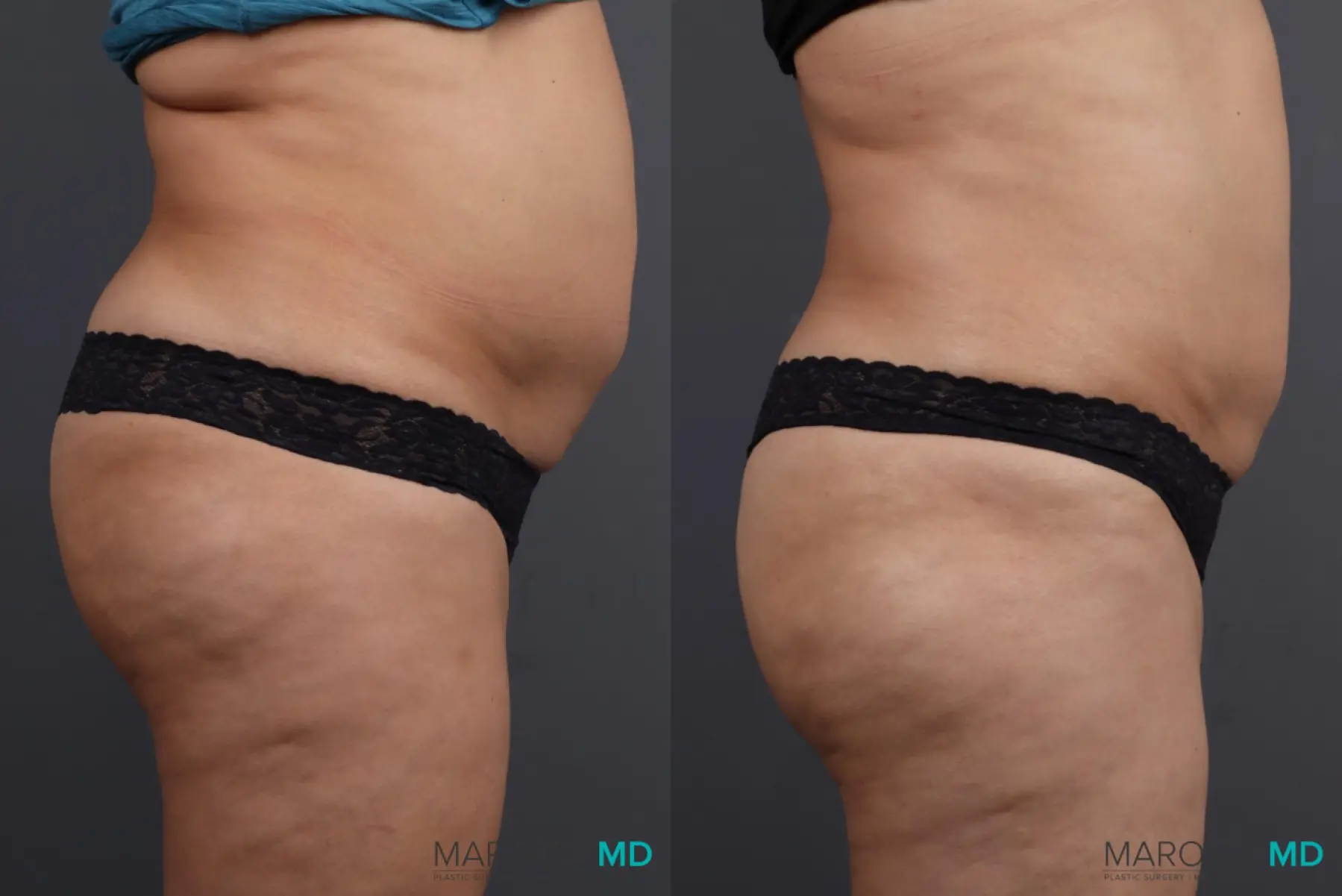 EMSCULPT®: Patient 1 - Before and After  