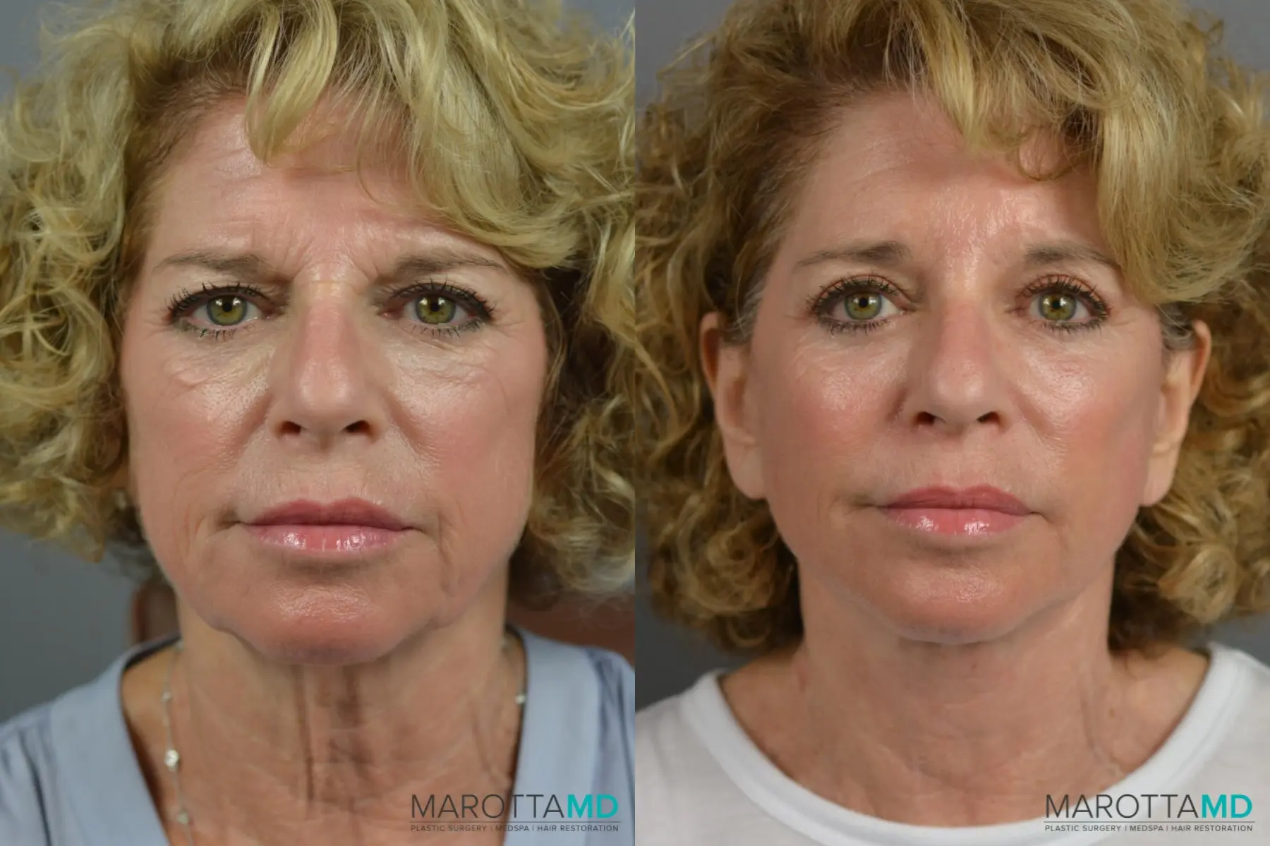 Endoscopic Brow Lift: Patient 1 - Before and After  