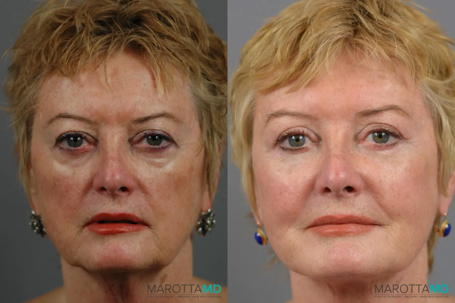 Eyelid Lift: Patient 1 - Before and After  