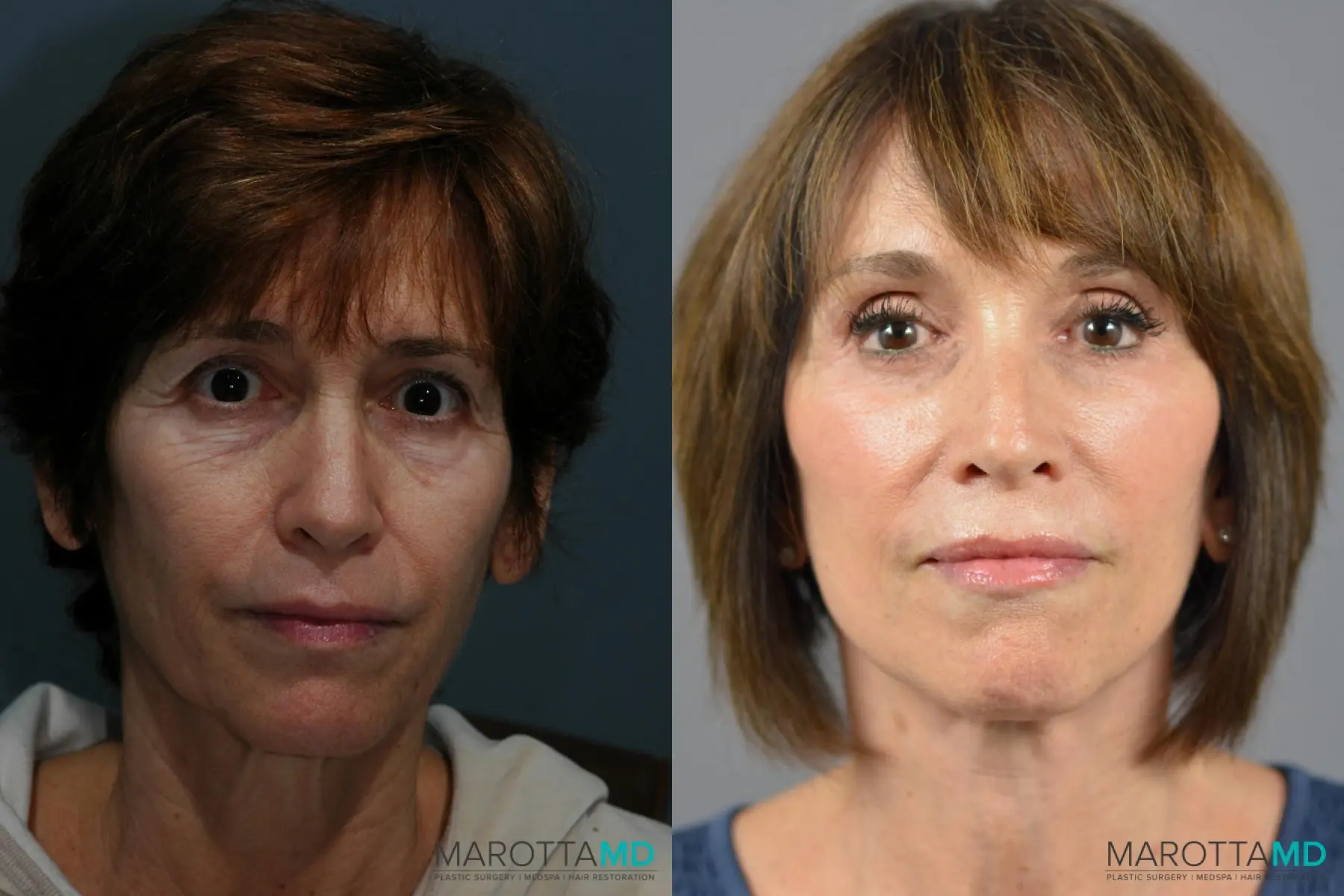 Facelift & Neck Lift: Patient 1 - Before and After  