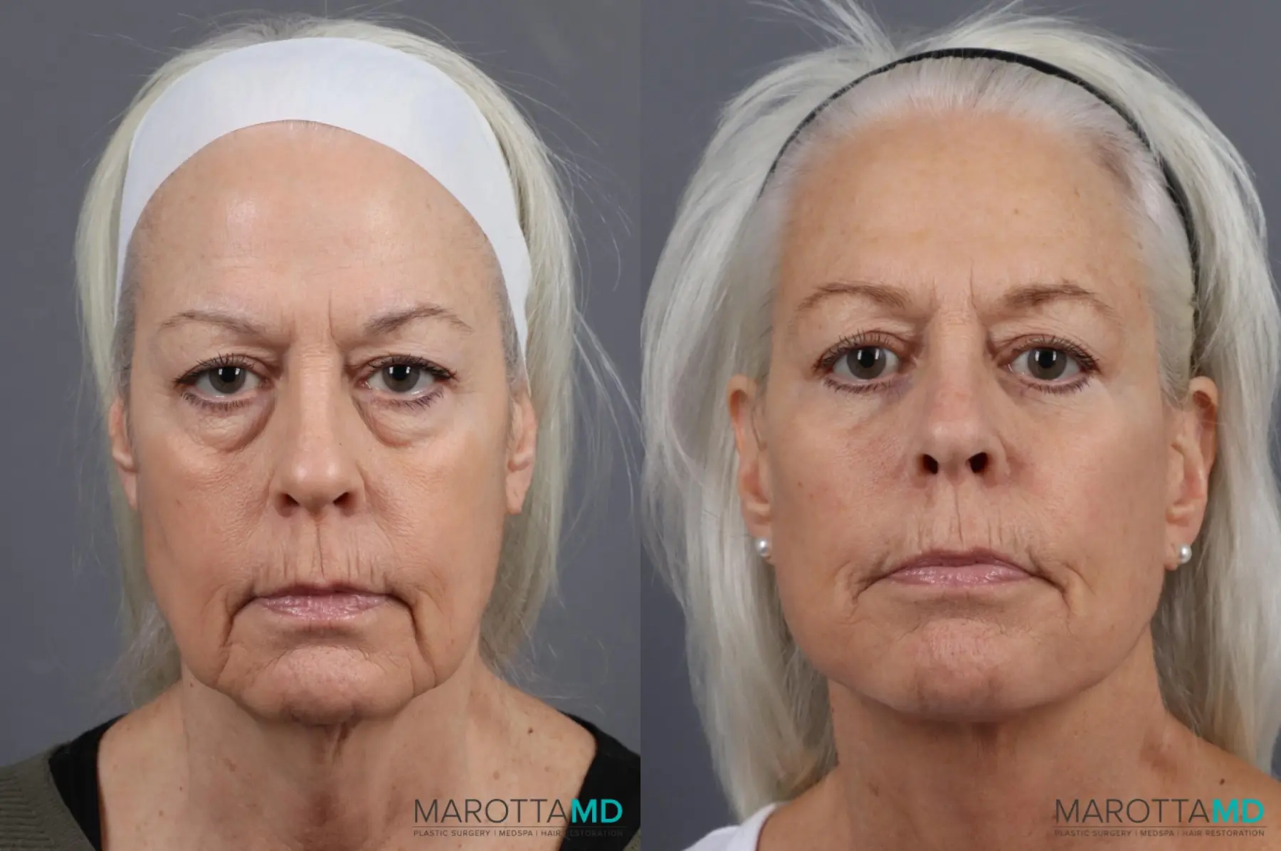 Facelift & Neck Lift: Patient 10 - Before and After  