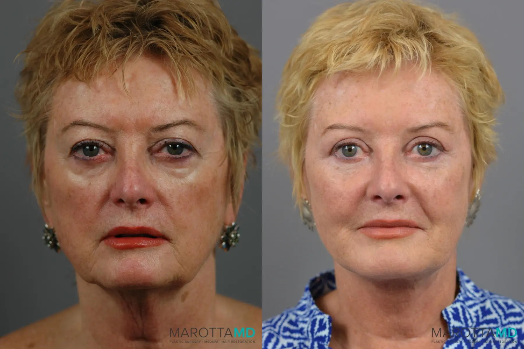 Facelift & Neck Lift: Patient 2 - Before and After  