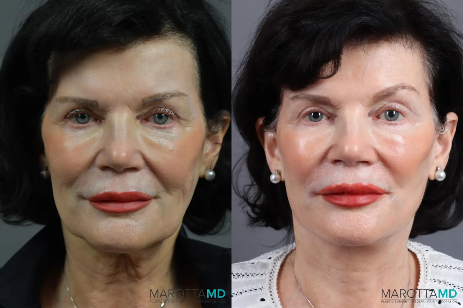 Facelift & Neck Lift: Patient 6 - Before and After  