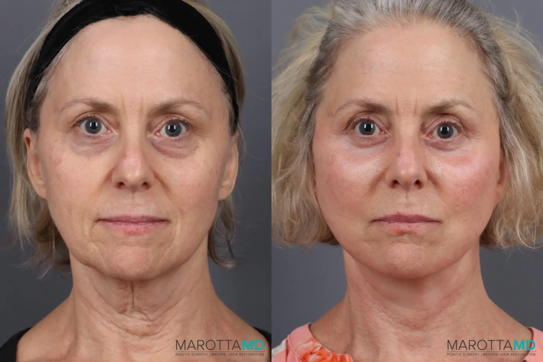 Facelift & Neck Lift: Patient 8 - Before and After  