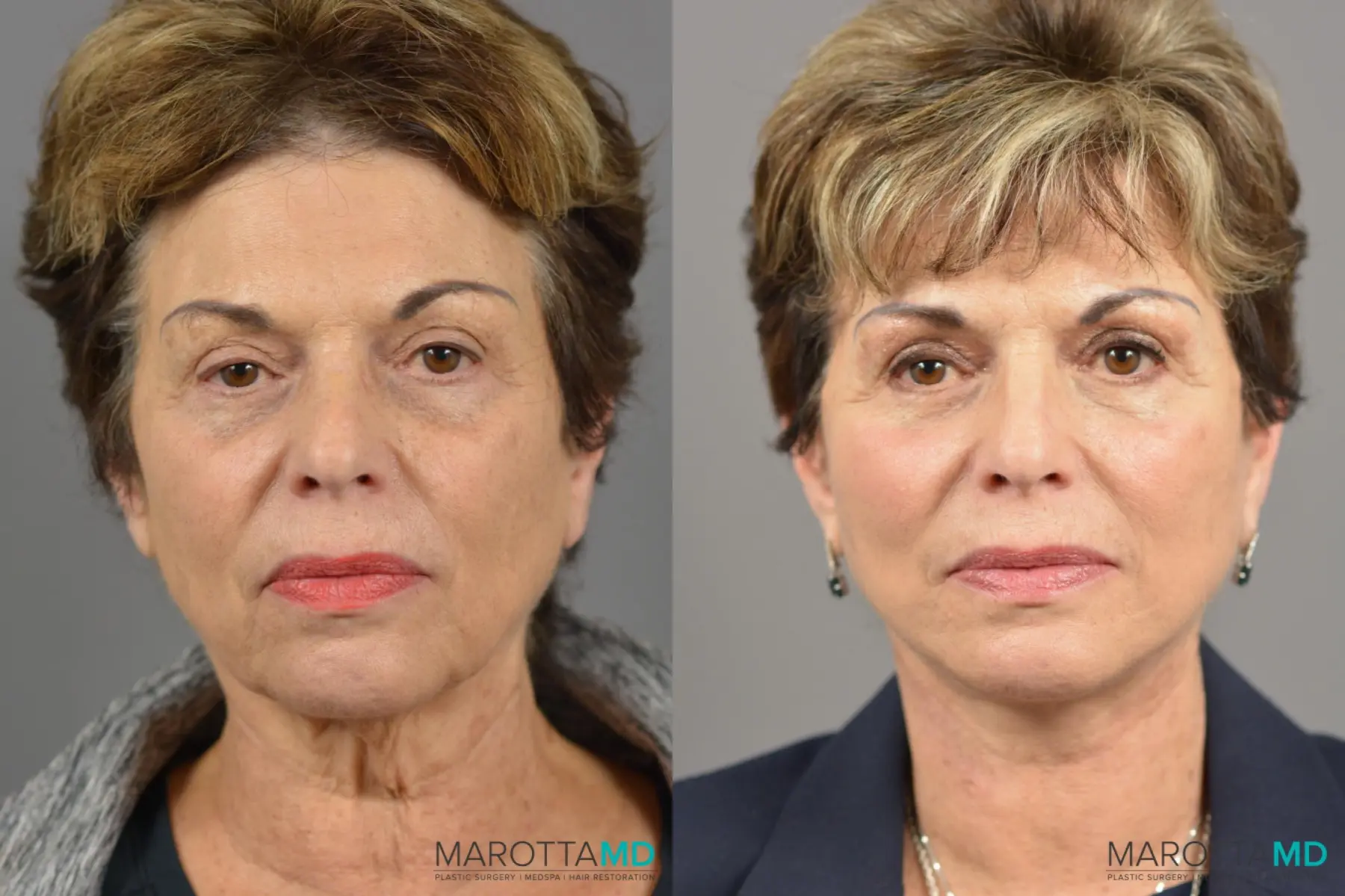 Facelift & Neck Lift: Patient 3 - Before and After  