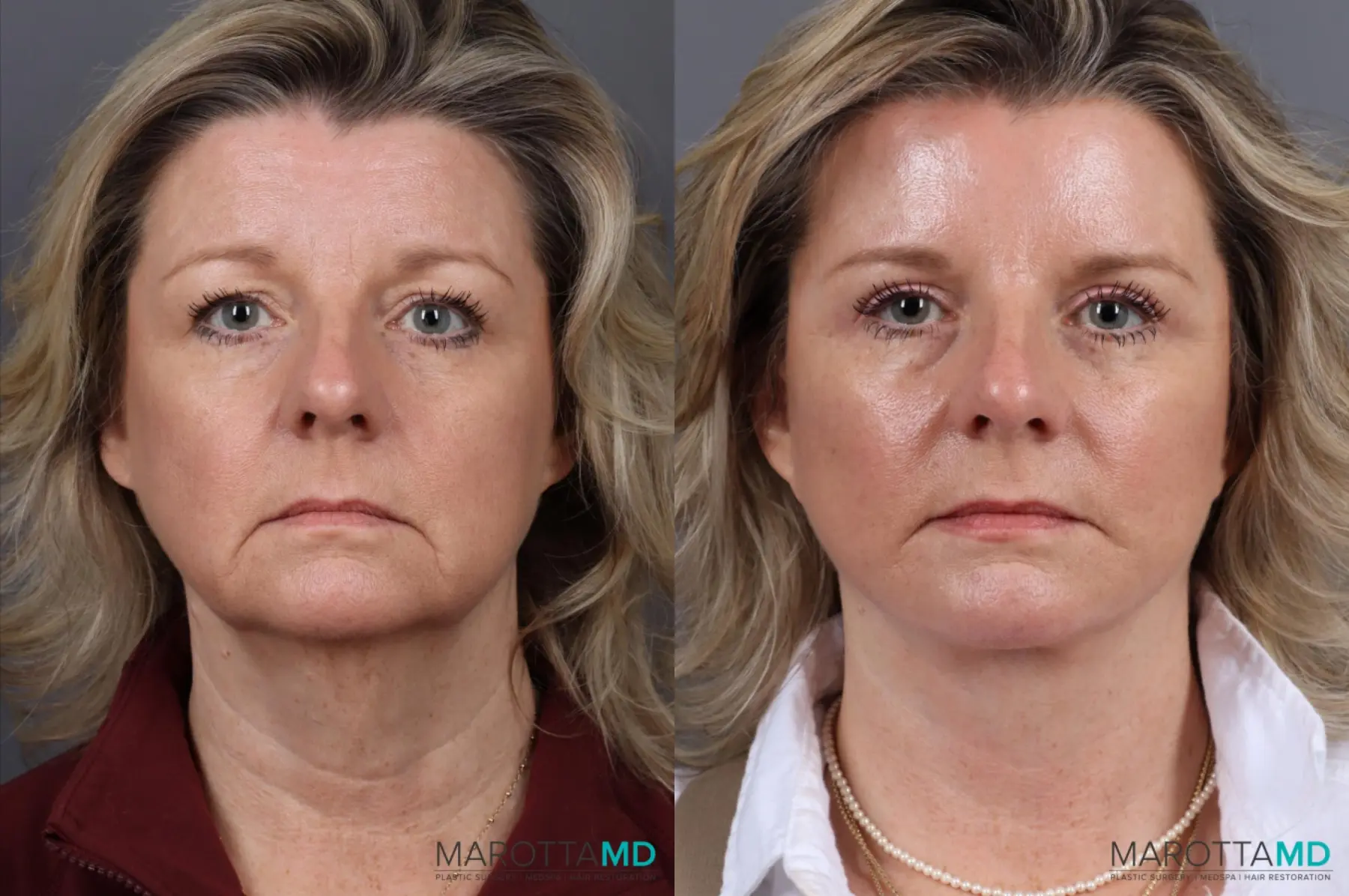 Facelift & Neck Lift: Patient 5 - Before and After  