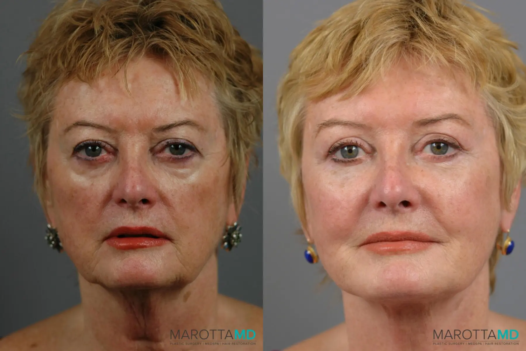 Fat Transfer - Face: Patient 1 - Before and After  