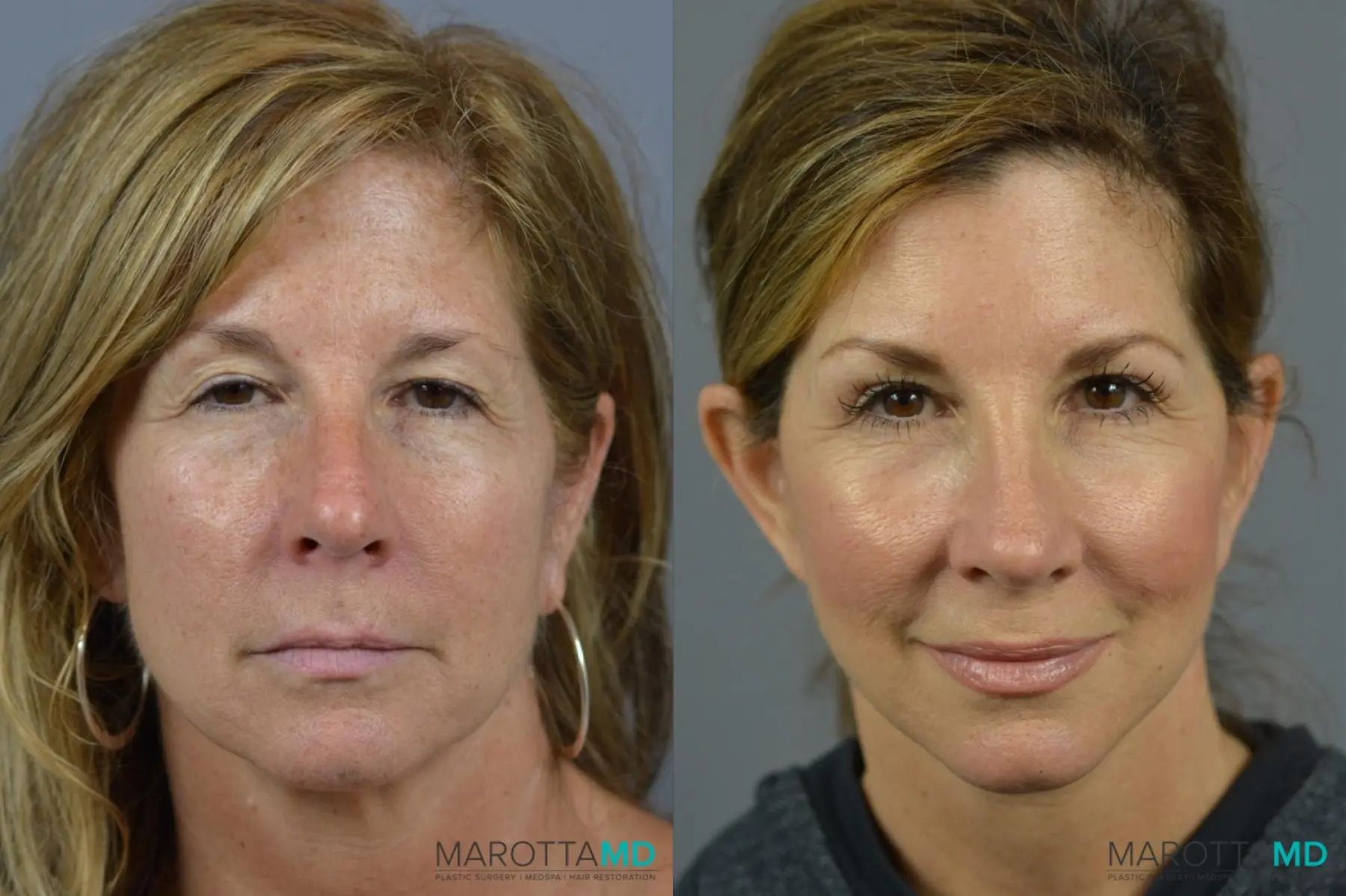 Fat Transfer - Face: Patient 2 - Before and After  