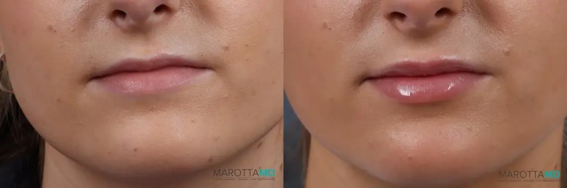 Filler - Lips: Patient 3 - Before and After  