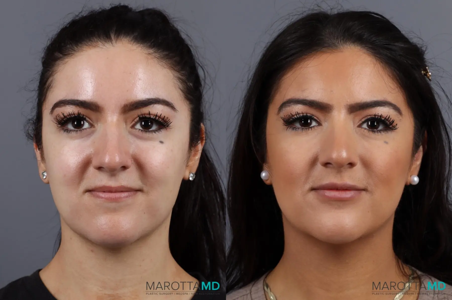 Filler - Lips: Patient 2 - Before and After  